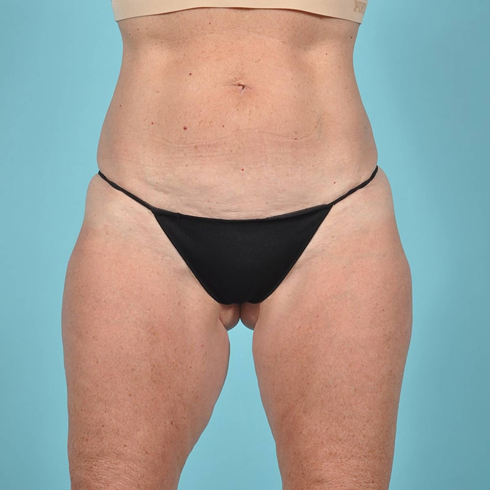 Thigh Lift Before & After Image