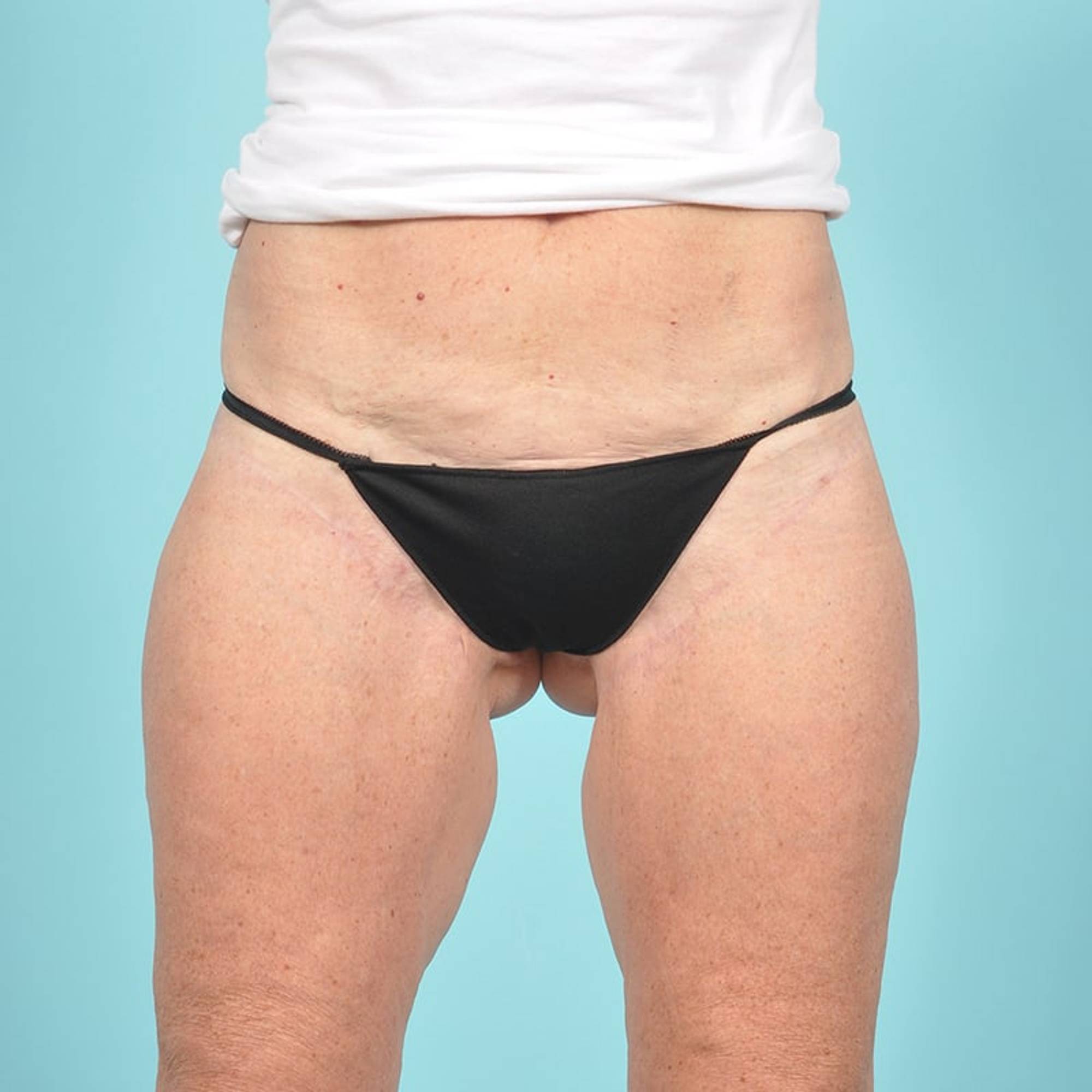 Thigh Lift Before & After Image