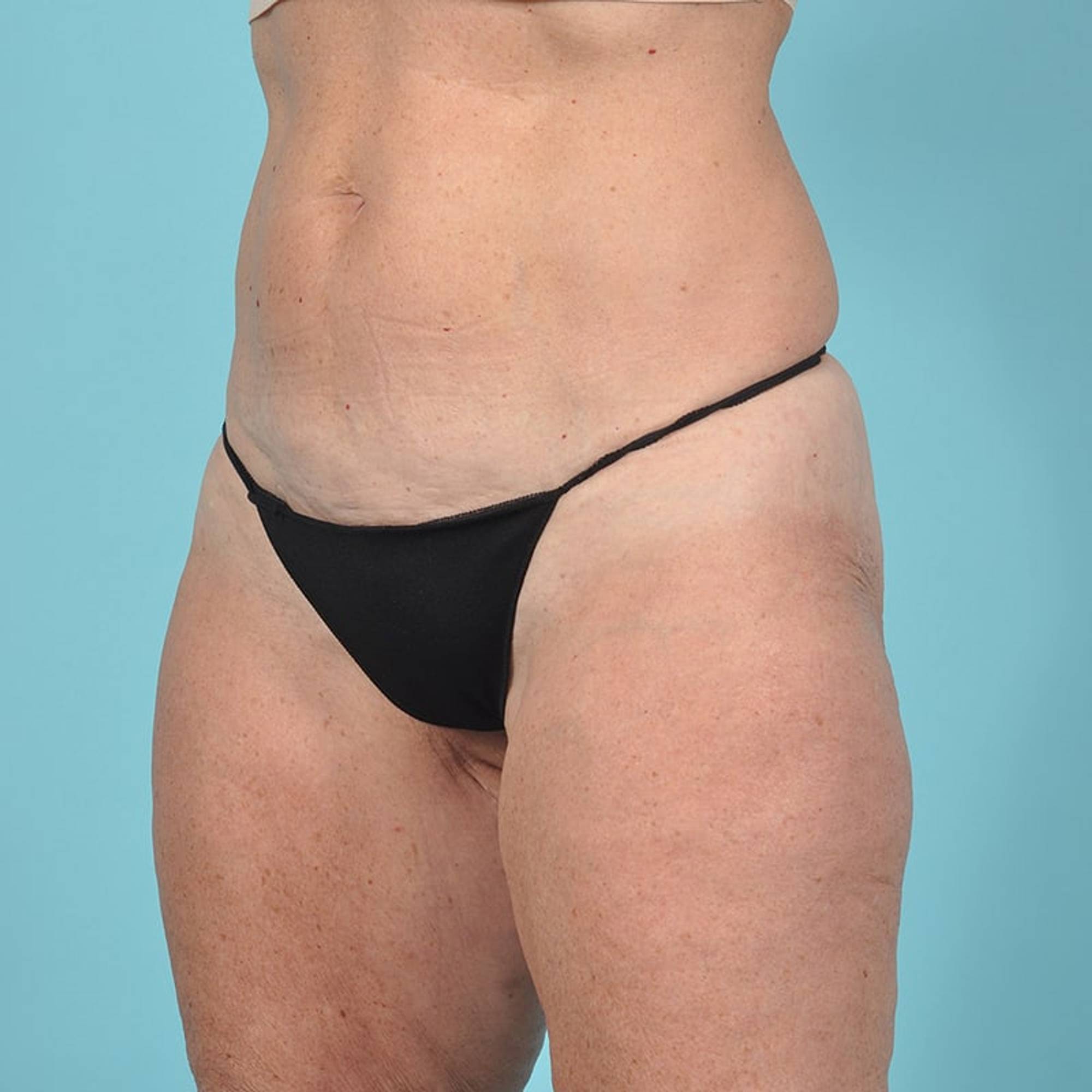 Thigh Lift Before & After Image