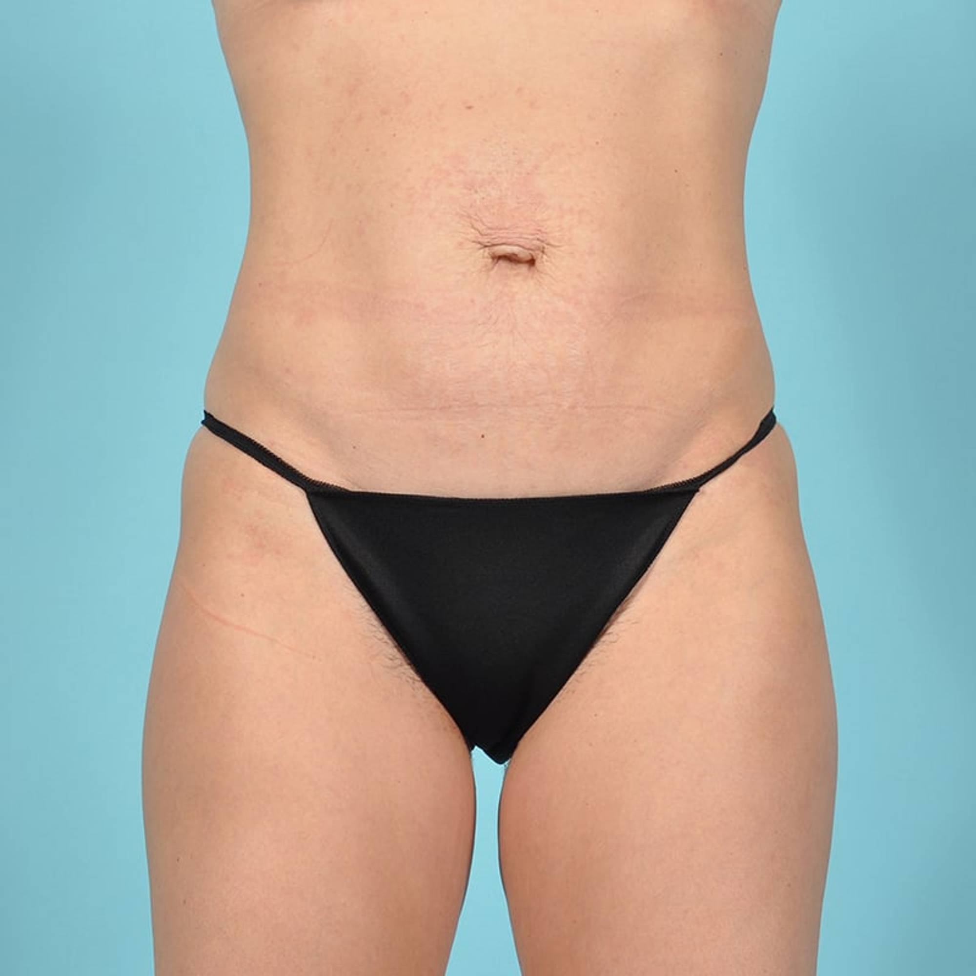 Tummy Tuck Before & After Image