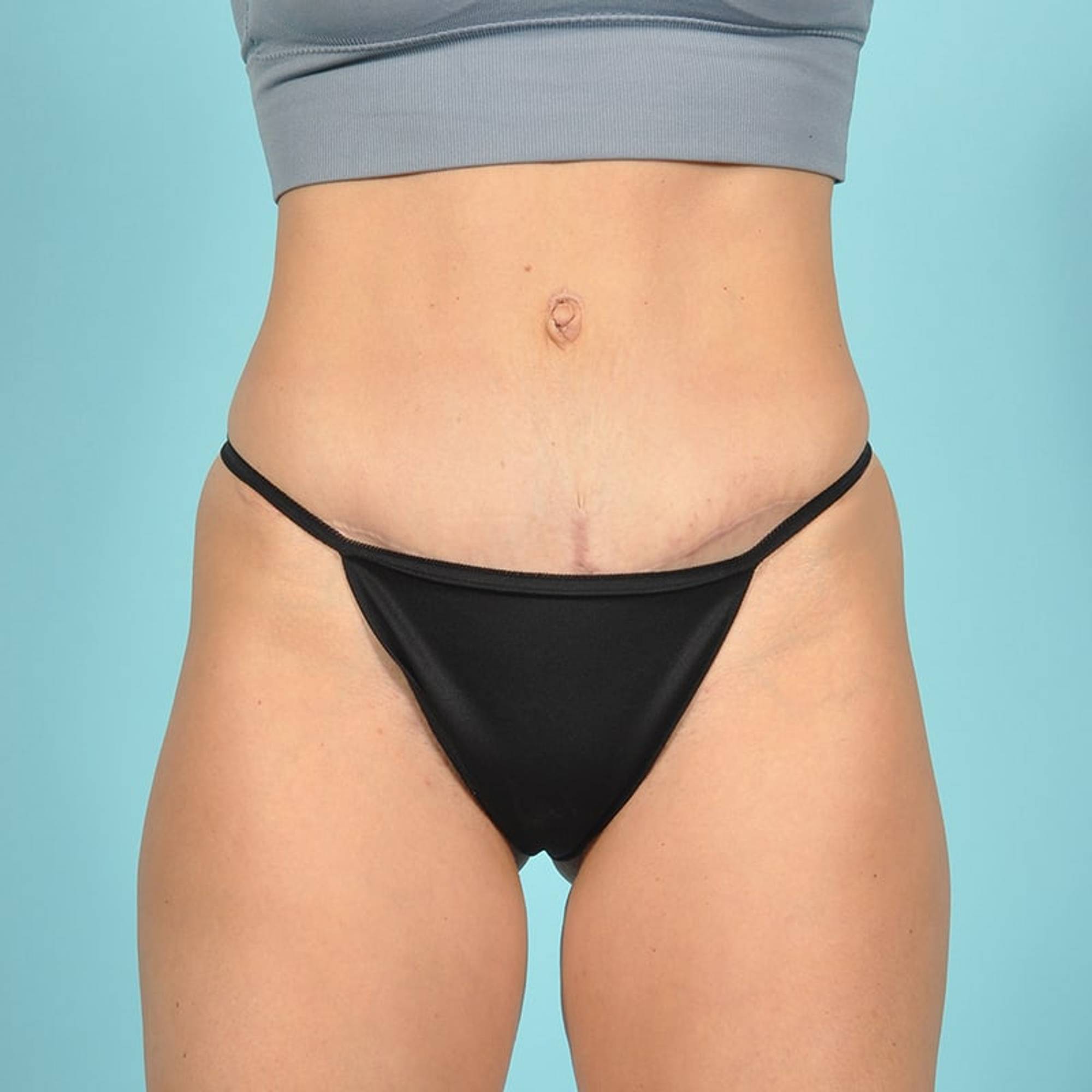 Tummy Tuck Before & After Image