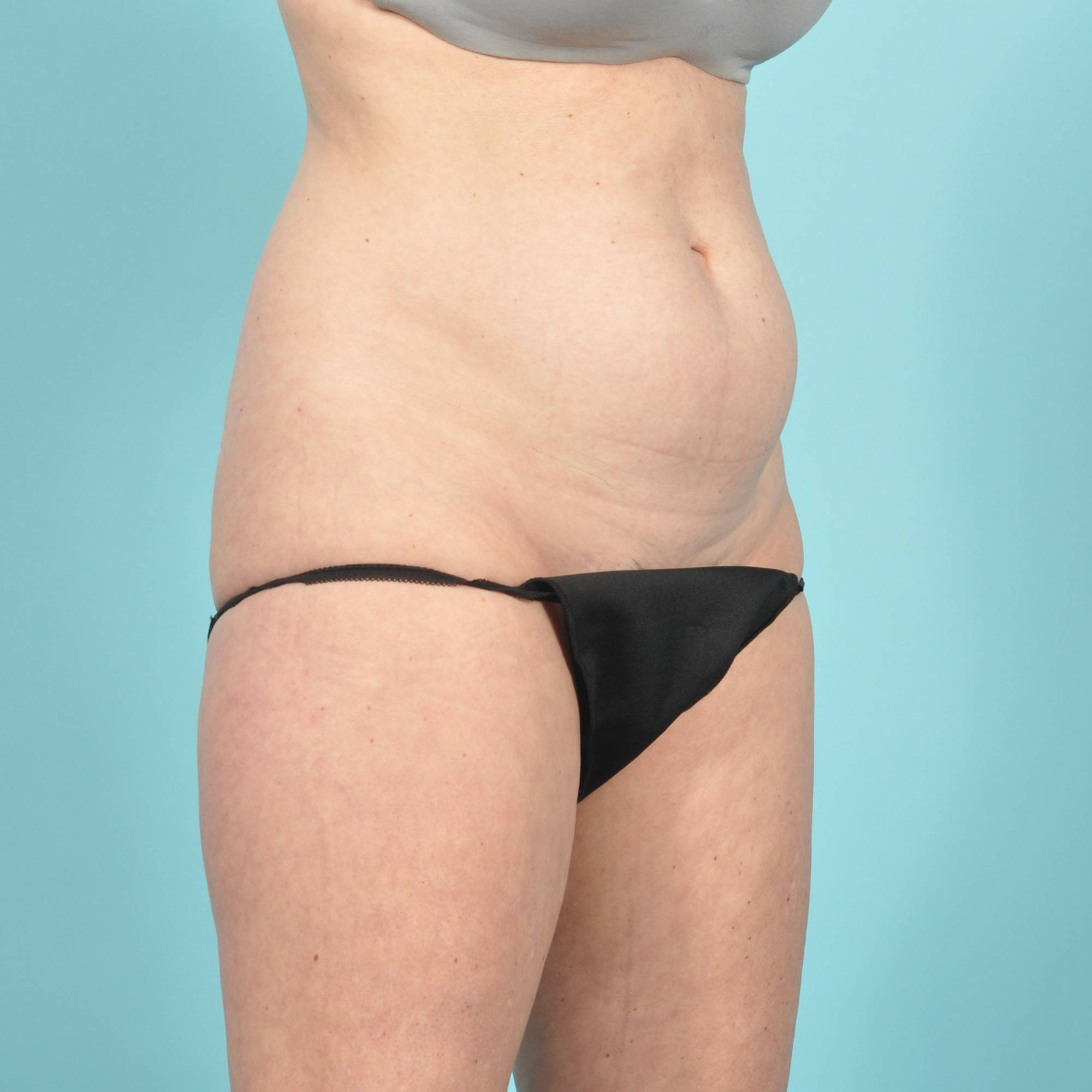 Tummy Tuck Before & After Image