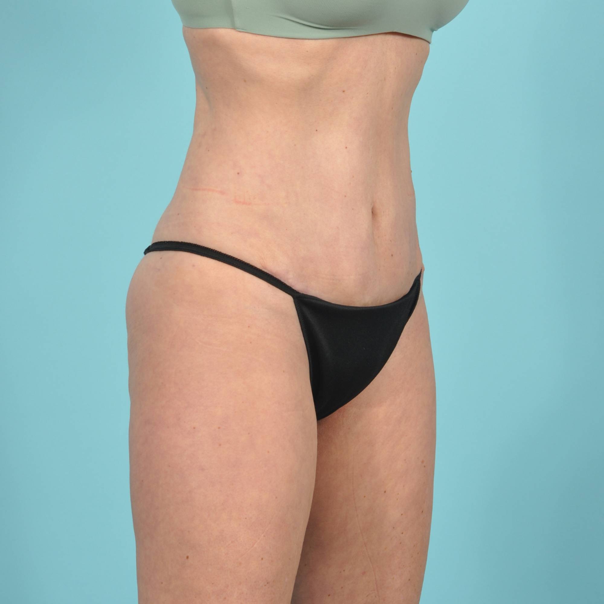 Tummy Tuck Before & After Image