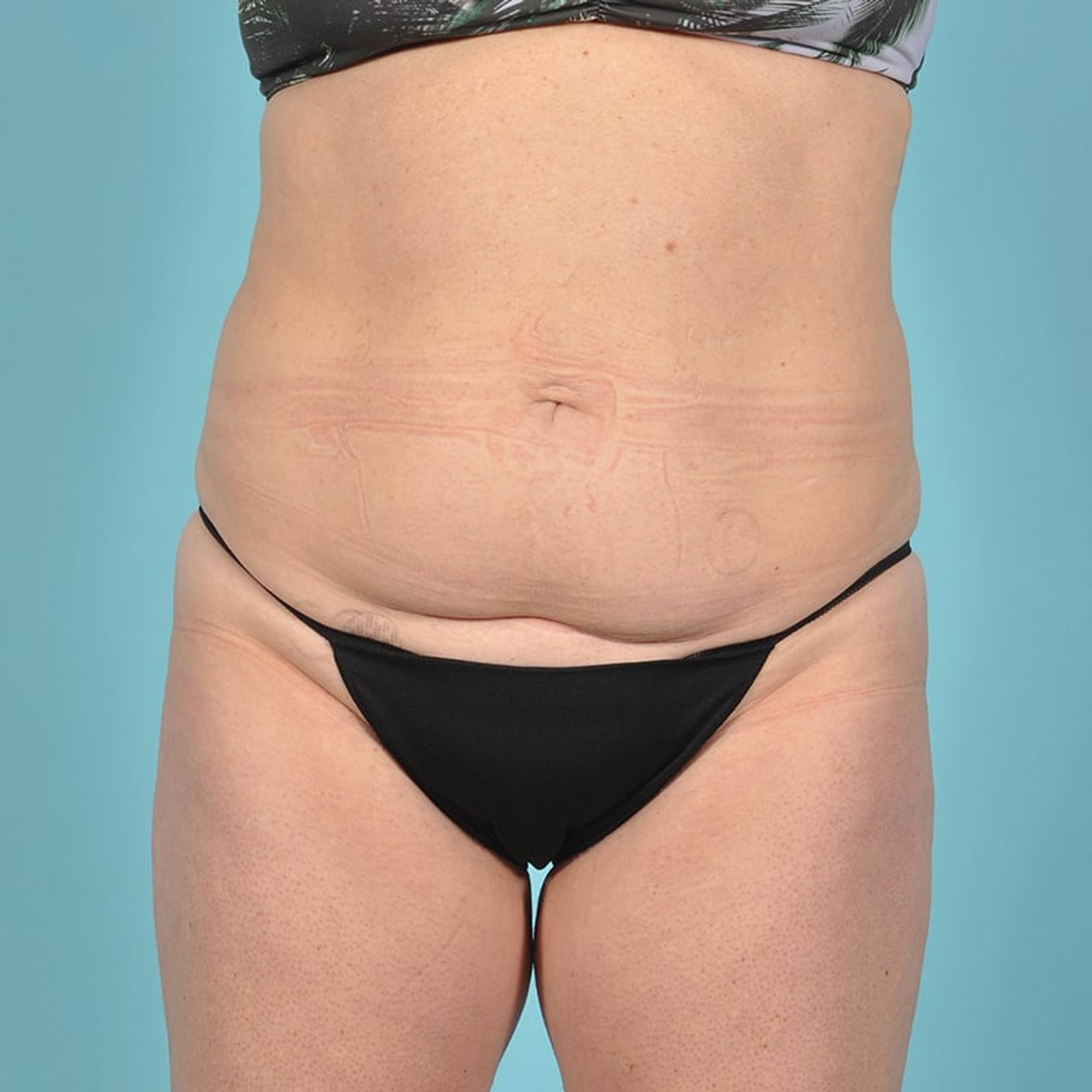 Tummy Tuck Before & After Image