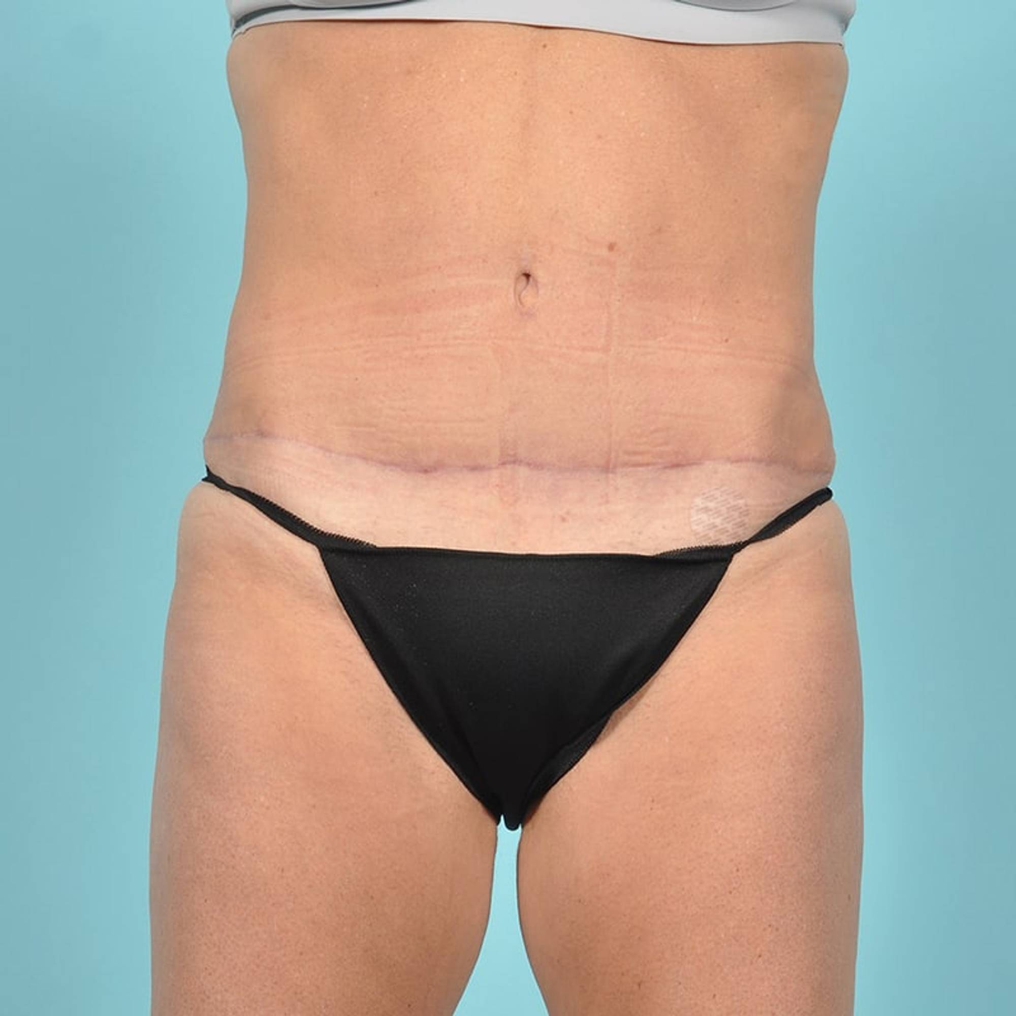 Tummy Tuck Before & After Image