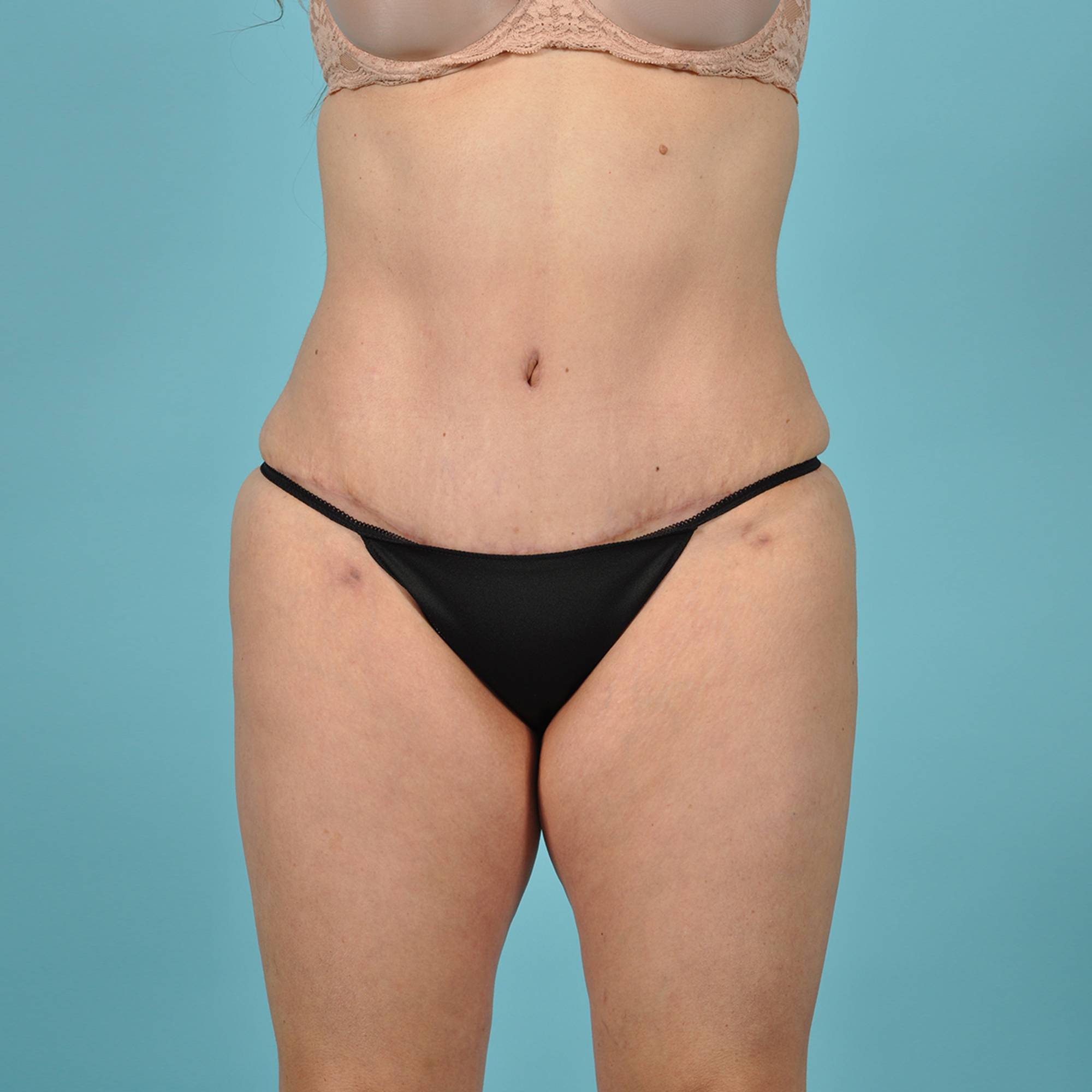 Tummy Tuck Before & After Image