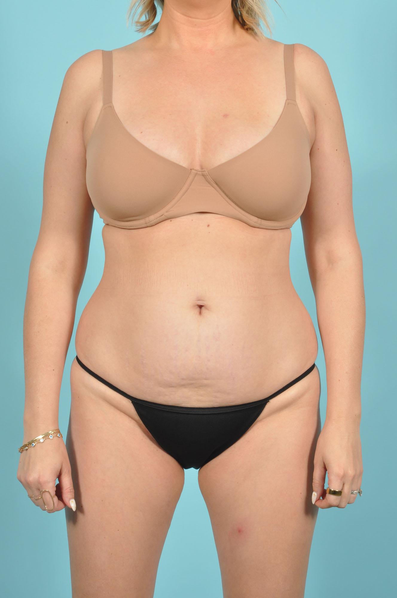 Tummy Tuck Before & After Image