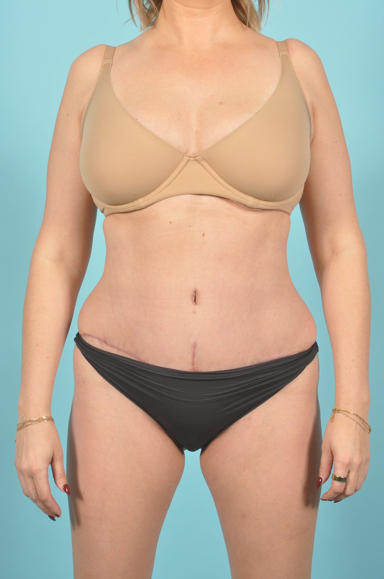Tummy Tuck Before & After Image