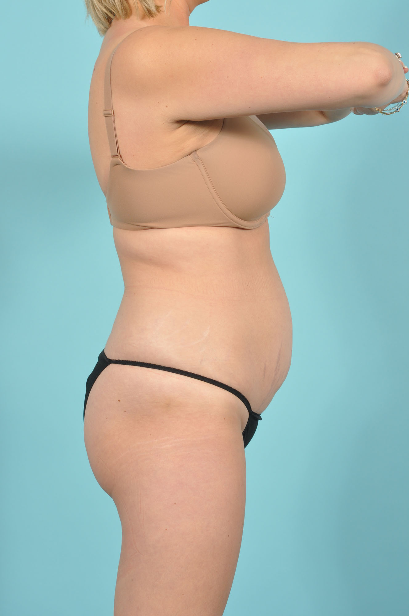 Tummy Tuck Before & After Image