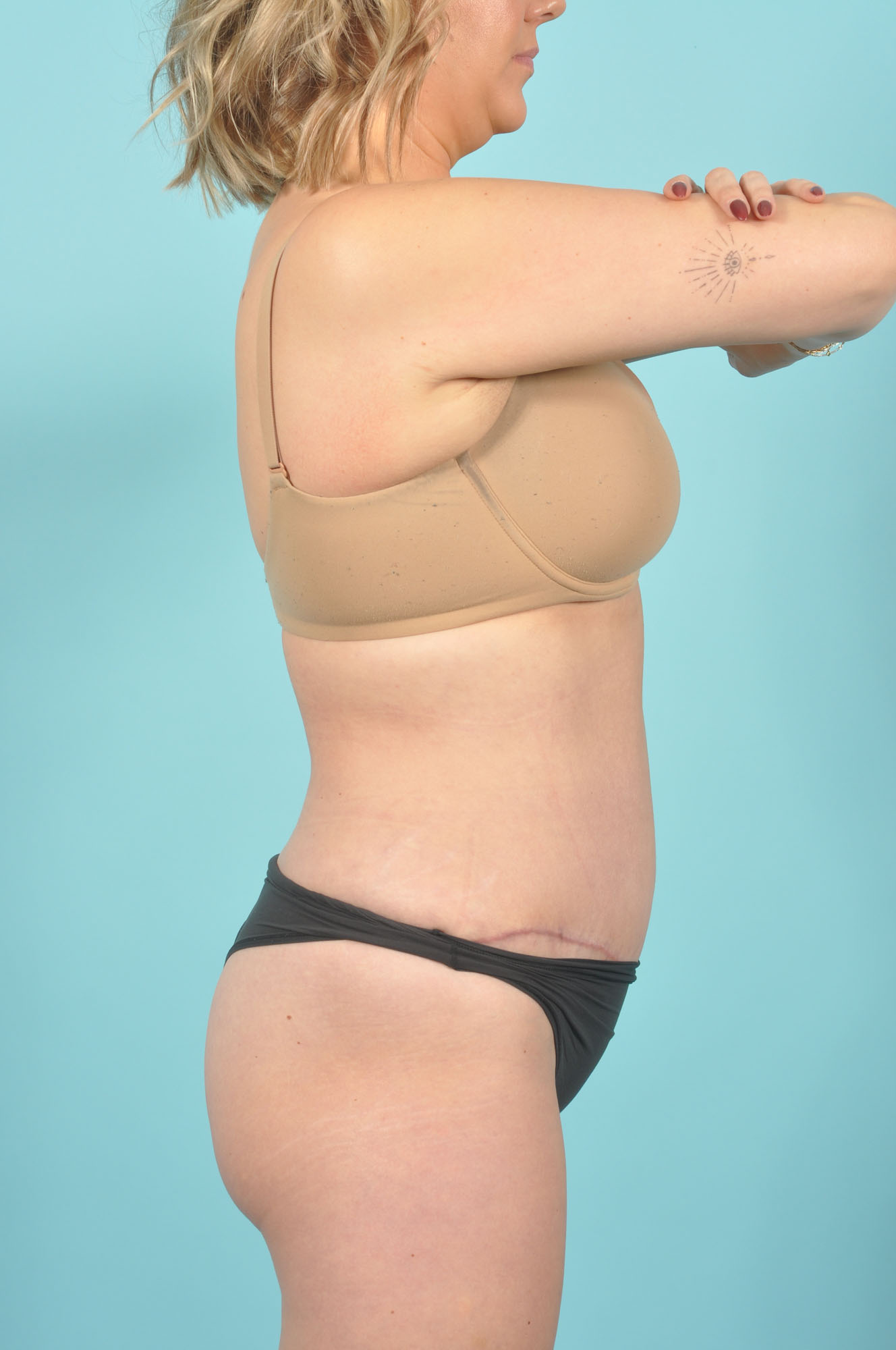 Tummy Tuck Before & After Image
