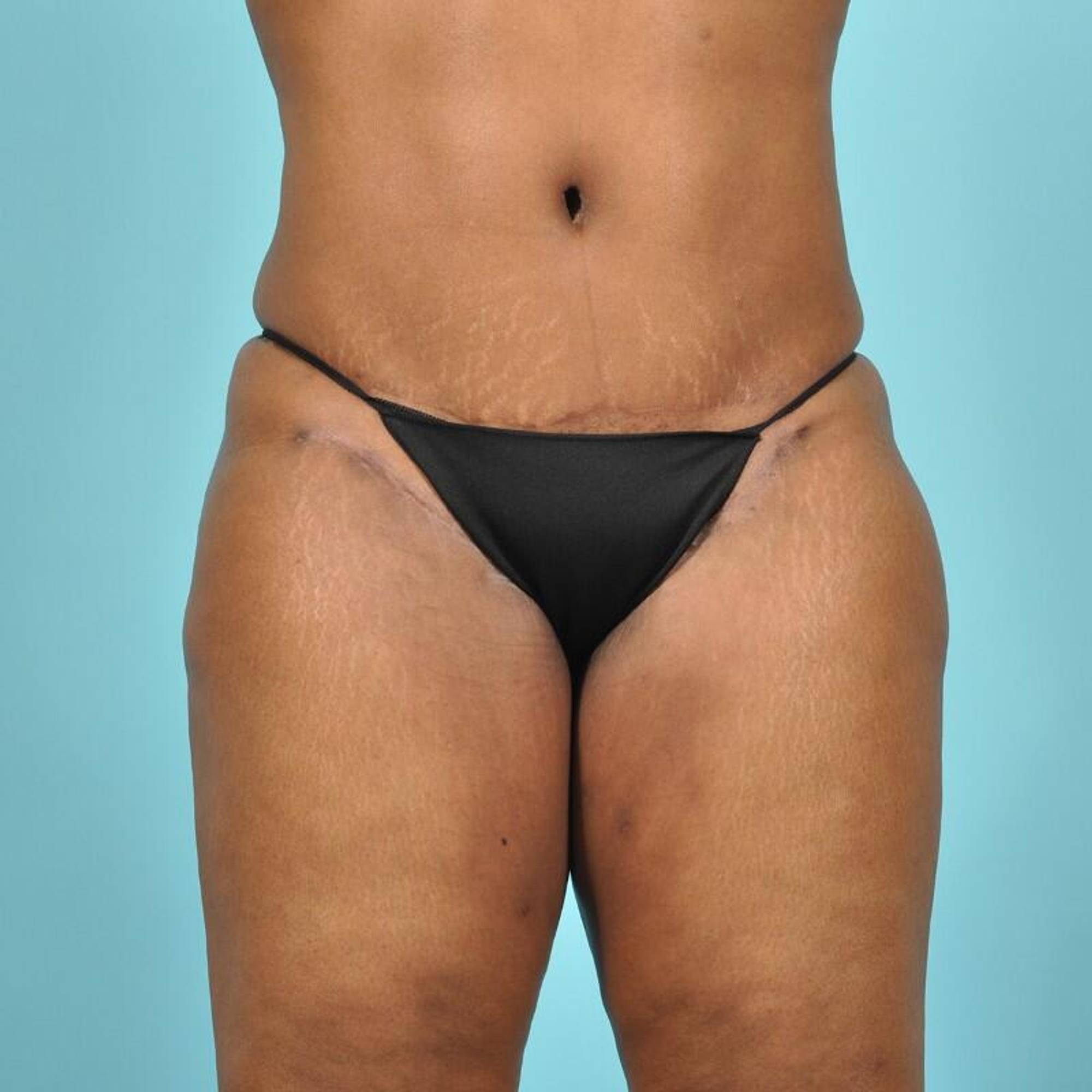 Tummy Tuck Before & After Image