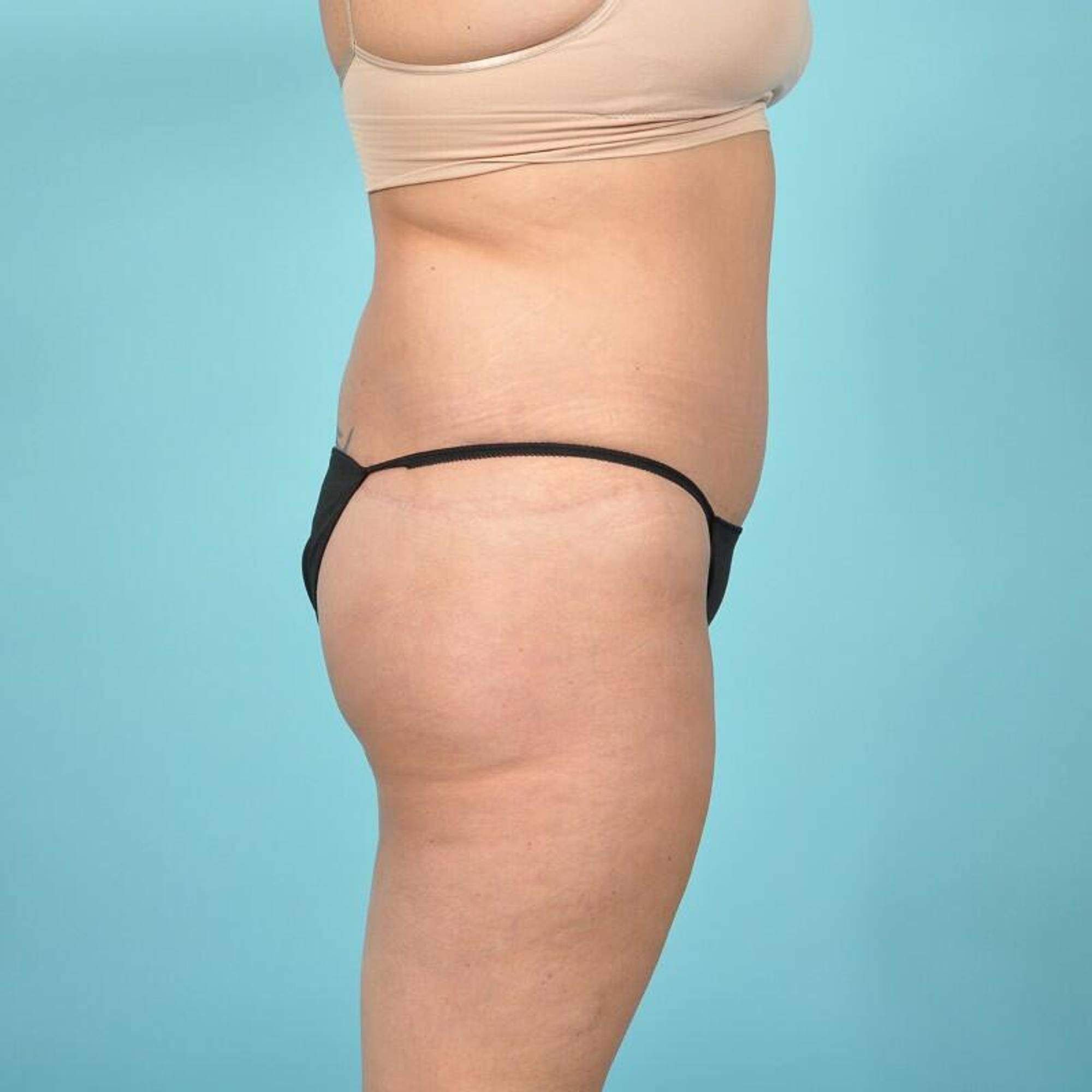 Tummy Tuck Before & After Image