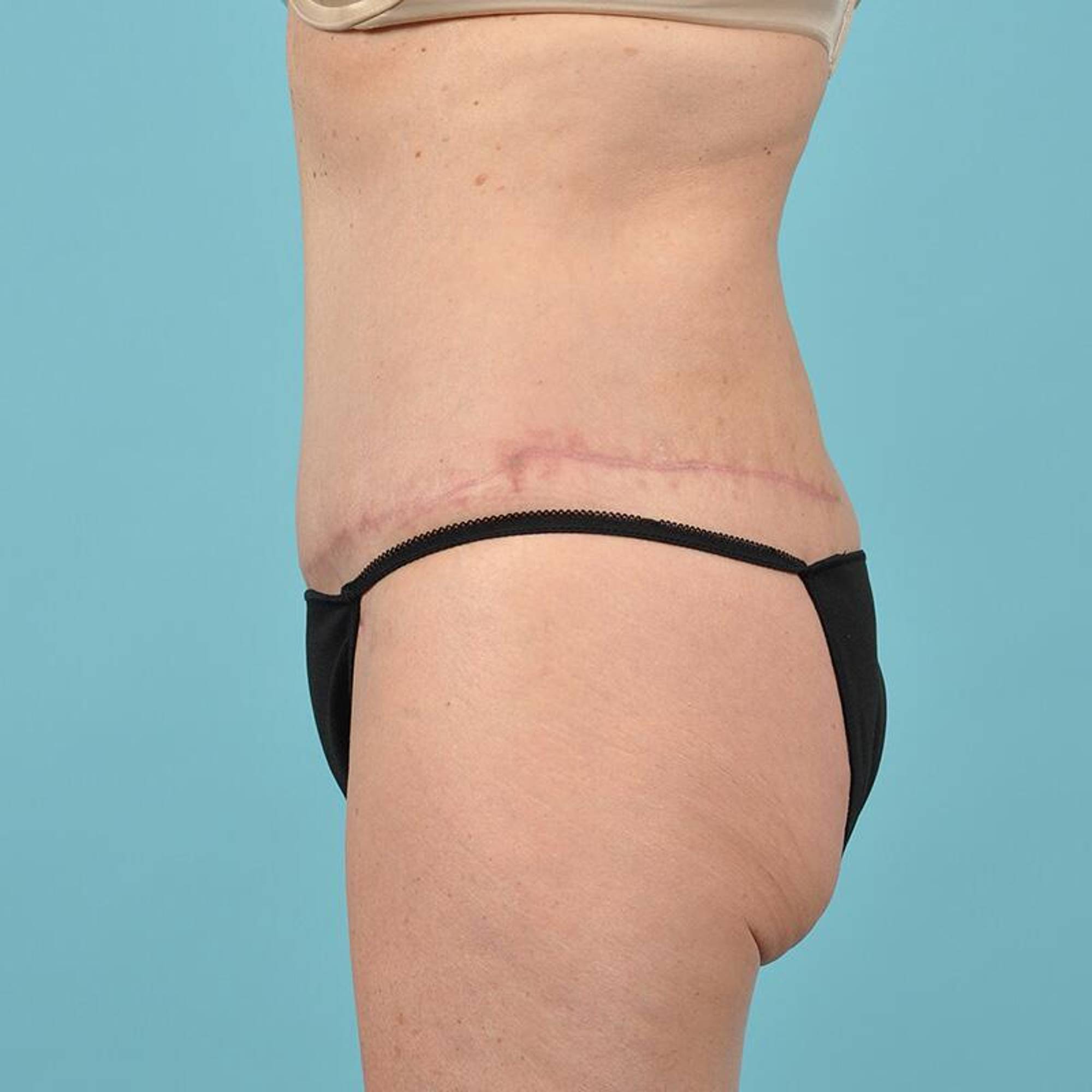 Tummy Tuck Before & After Image