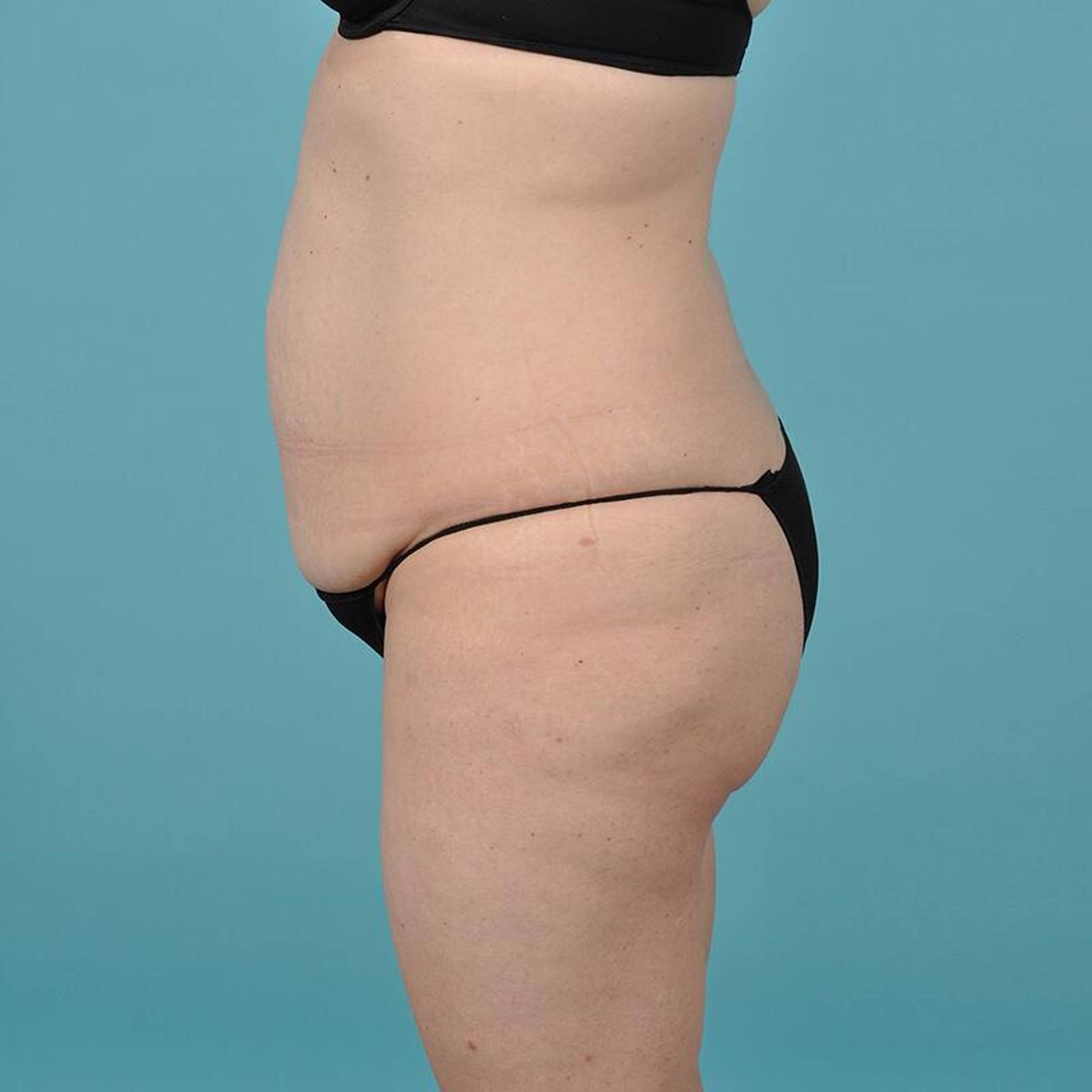 Tummy Tuck Before & After Image