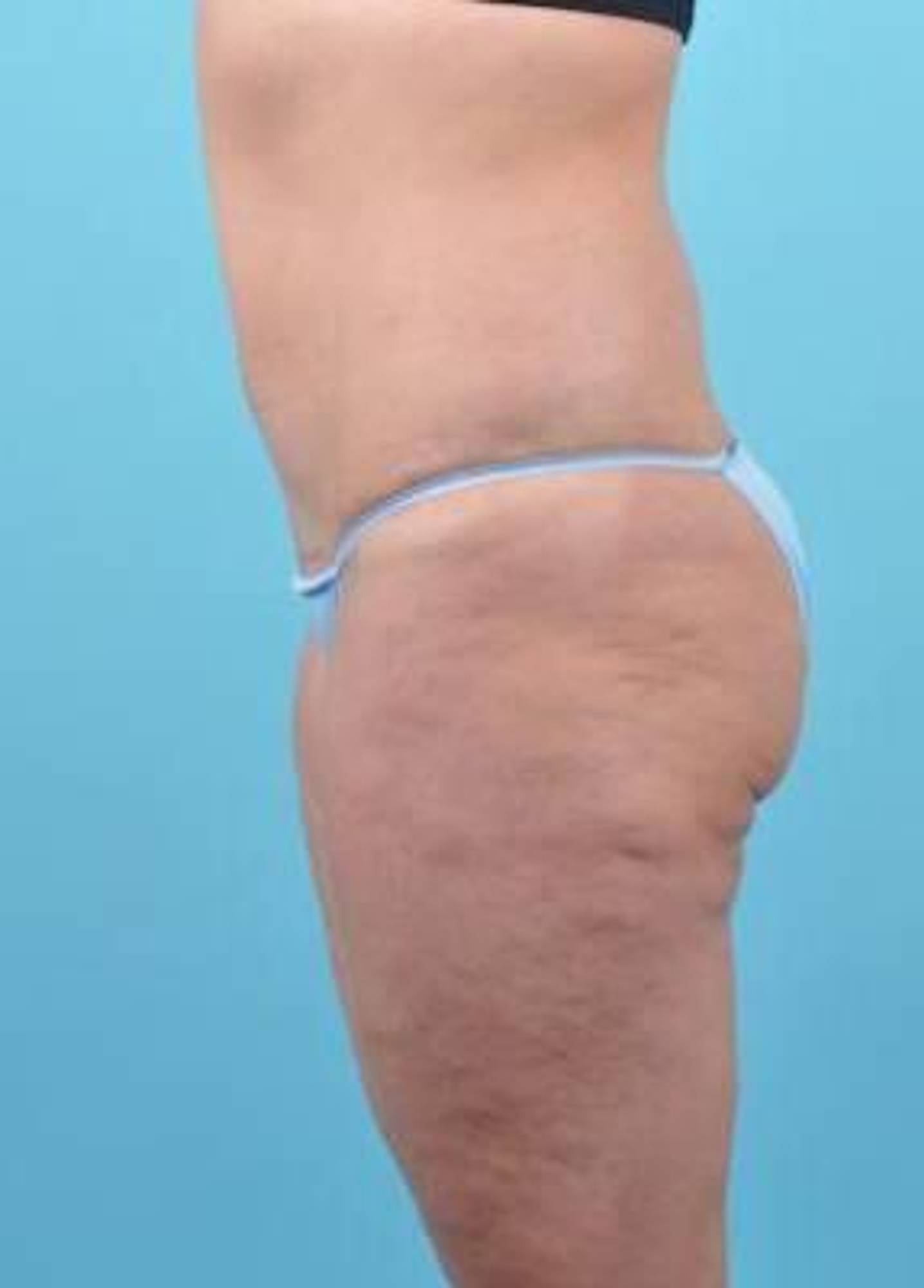 Tummy Tuck Before & After Image