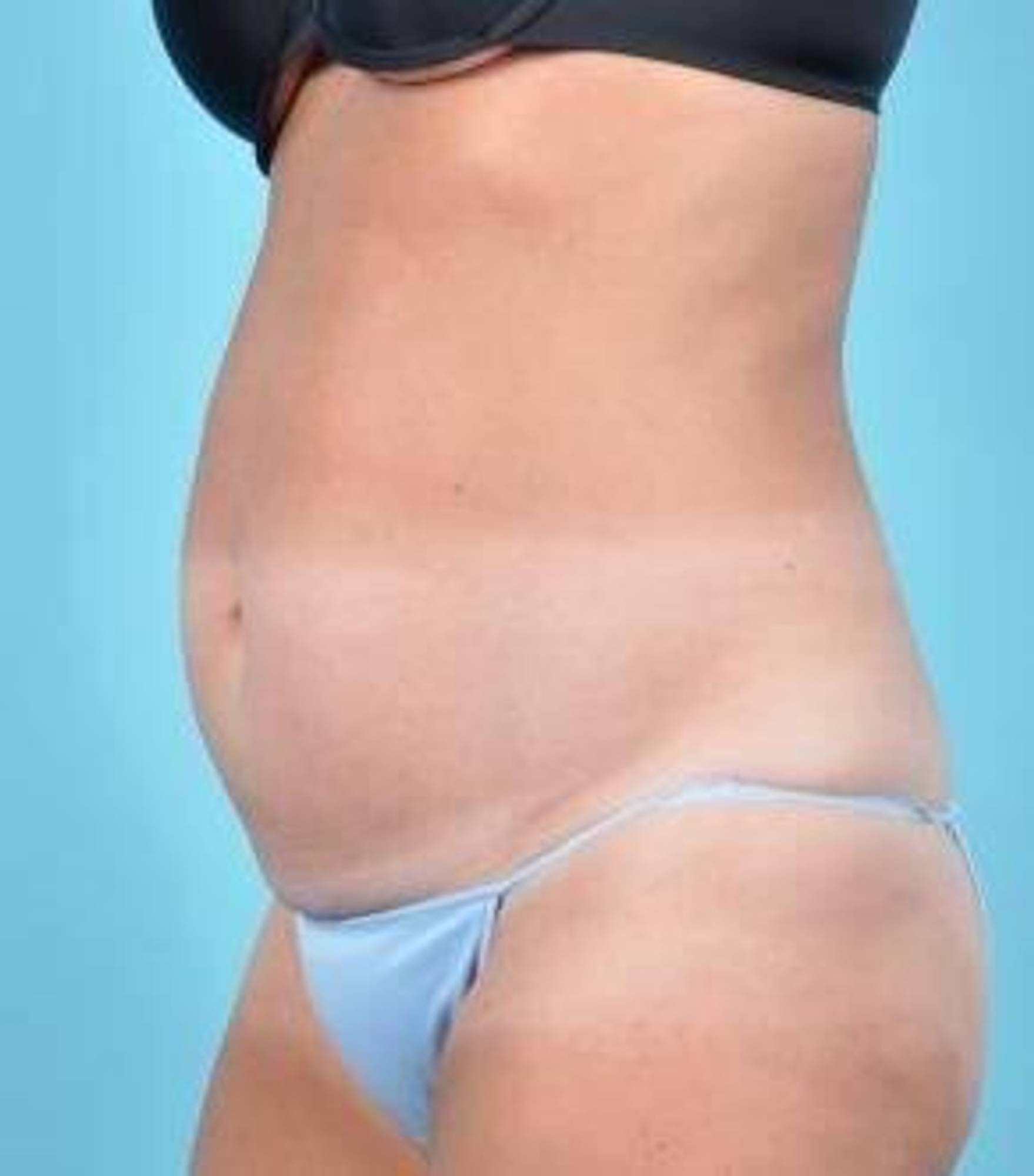 Tummy Tuck Before & After Image