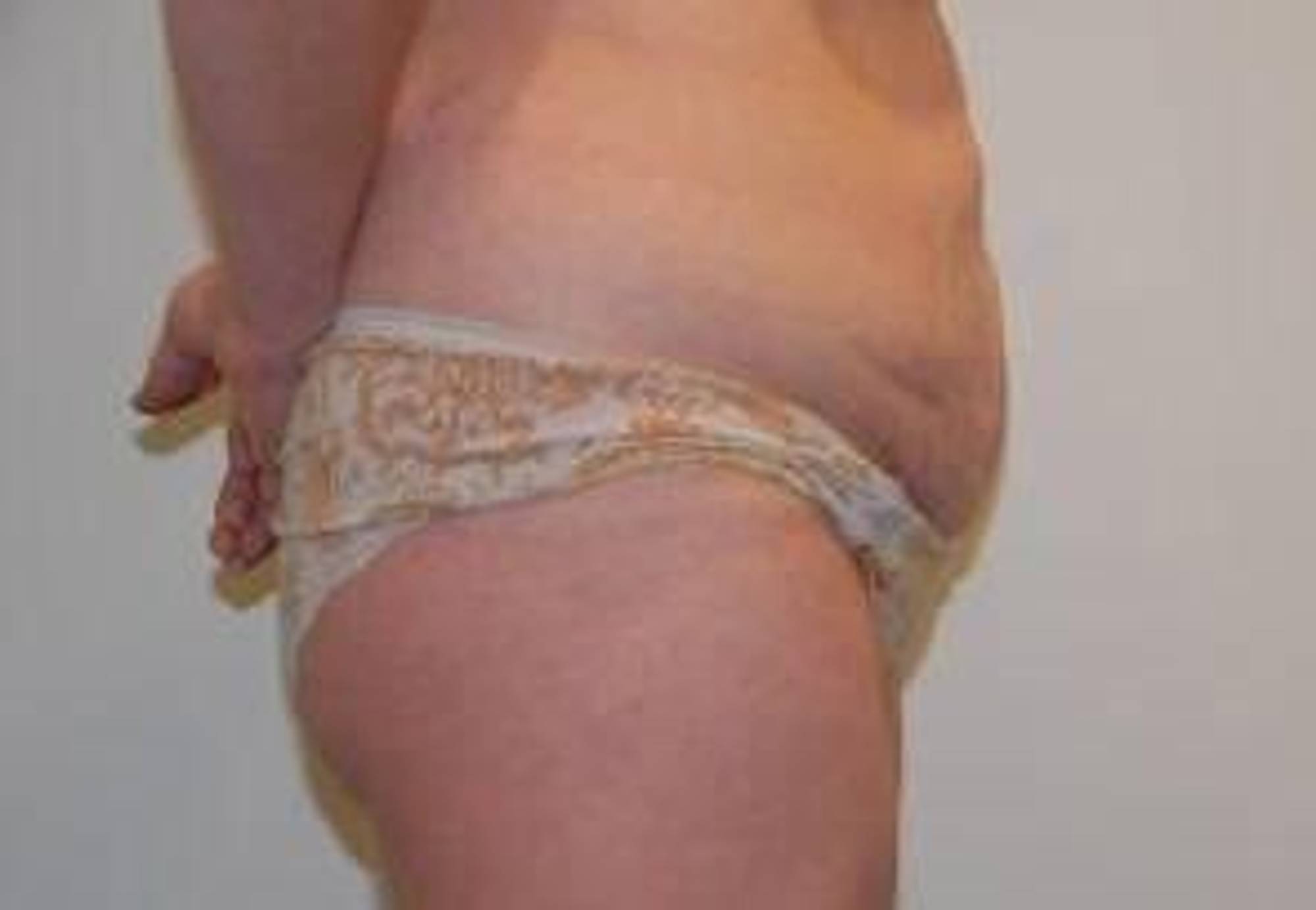 Tummy Tuck Before & After Image