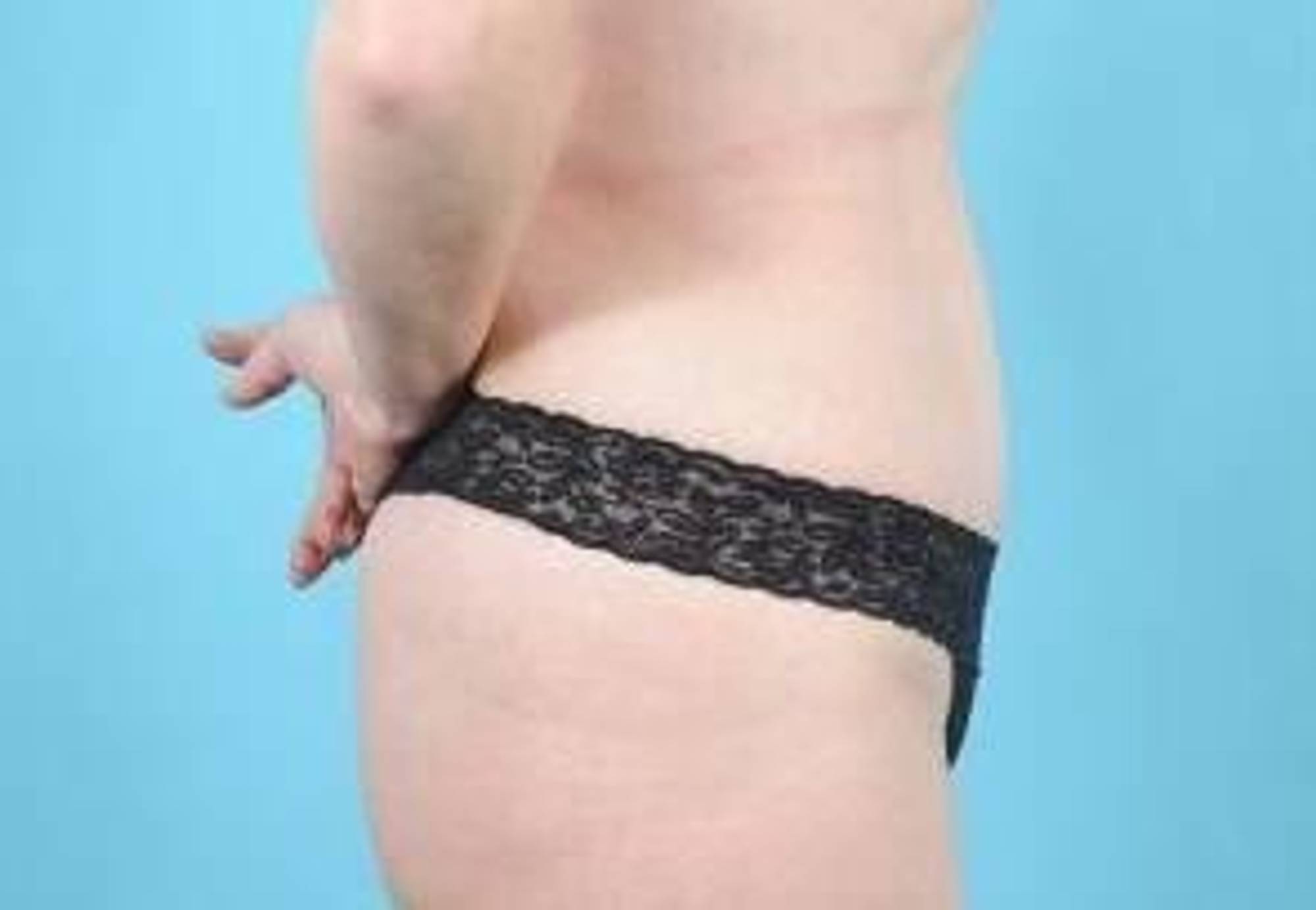 Tummy Tuck Before & After Image