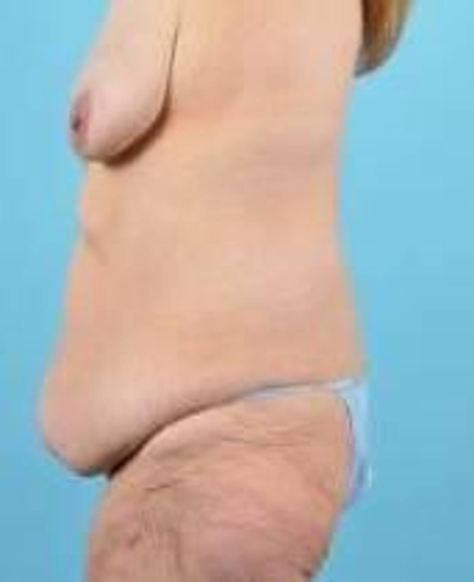 Tummy Tuck Before & After Image