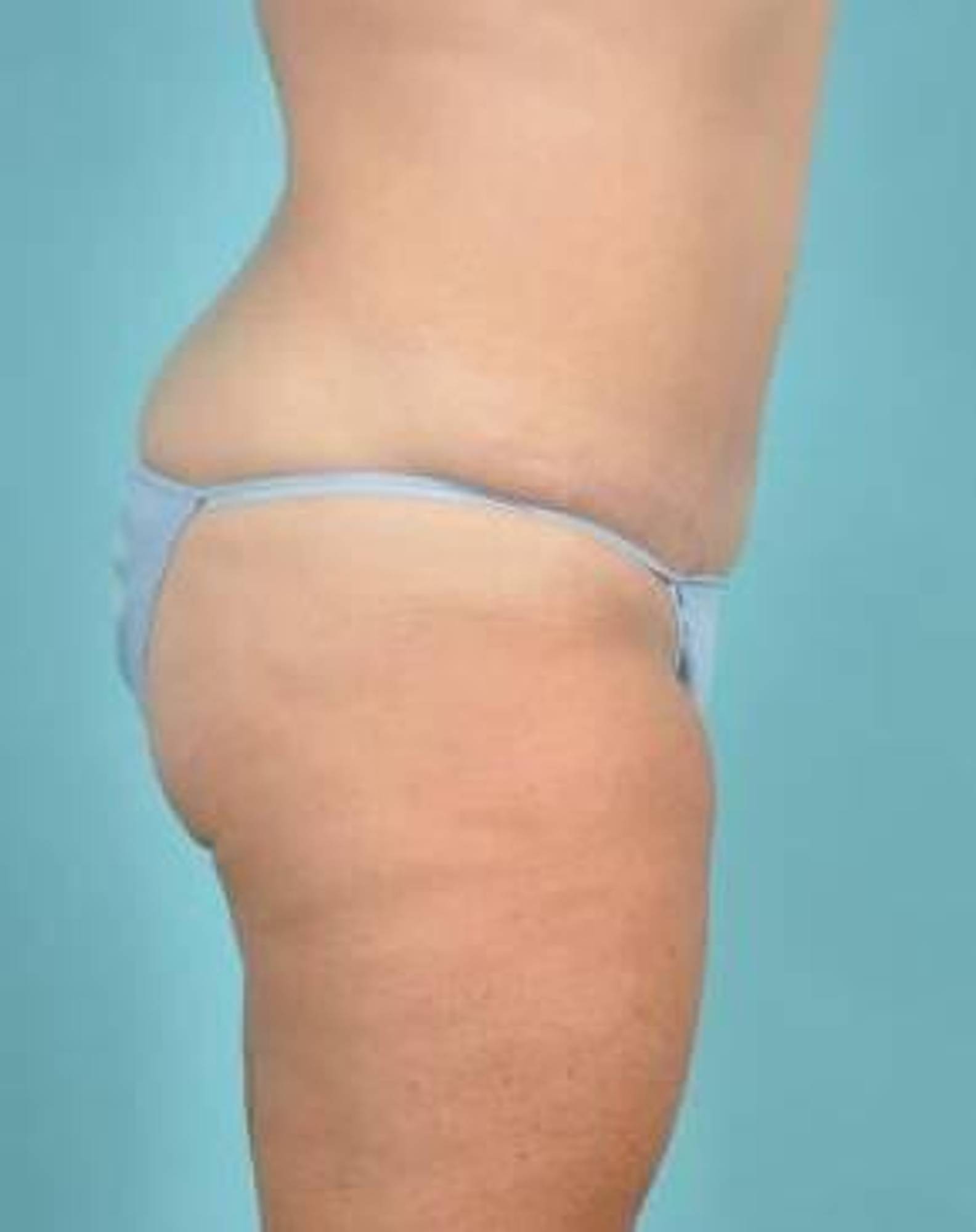 Tummy Tuck Before & After Image