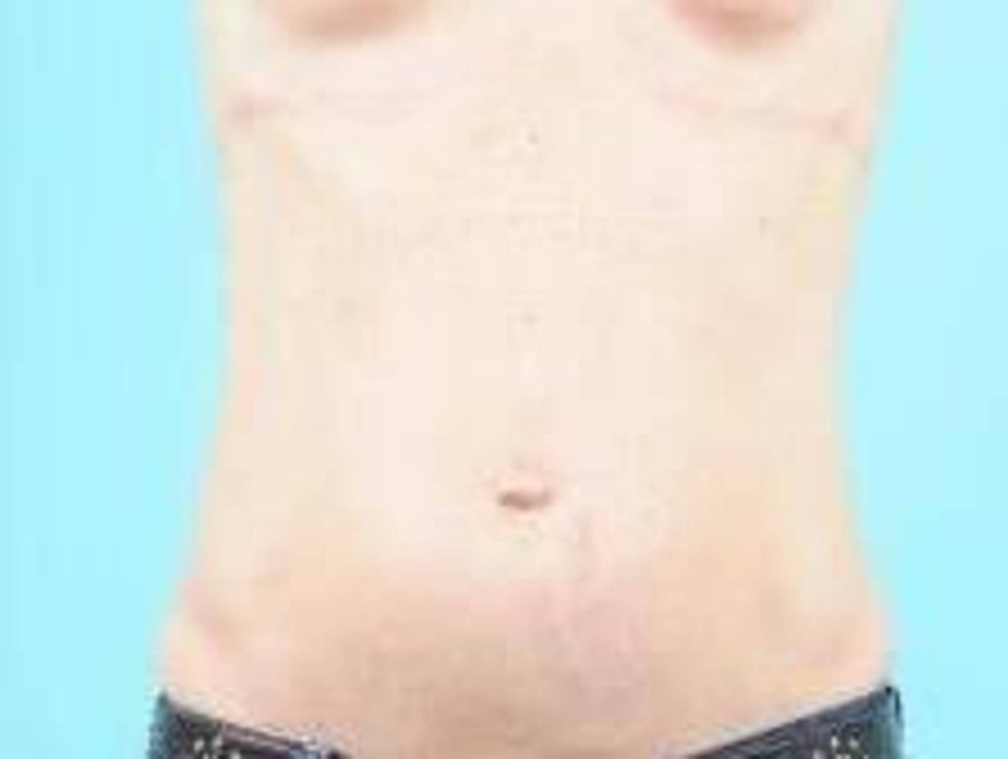 Tummy Tuck Before & After Image