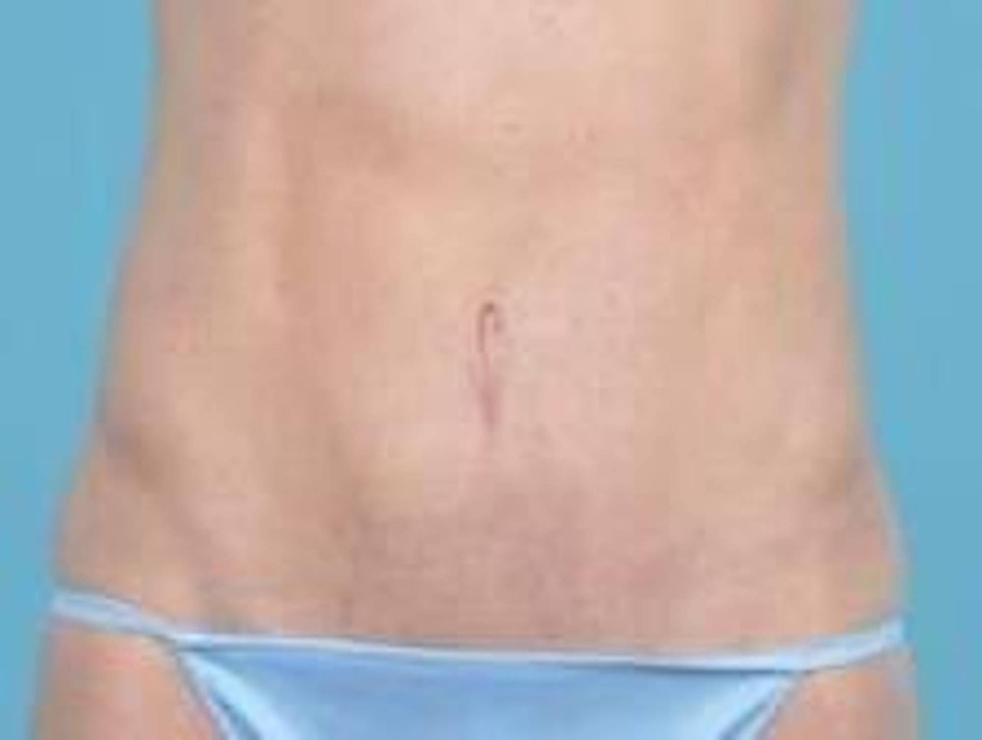 Tummy Tuck Before & After Image