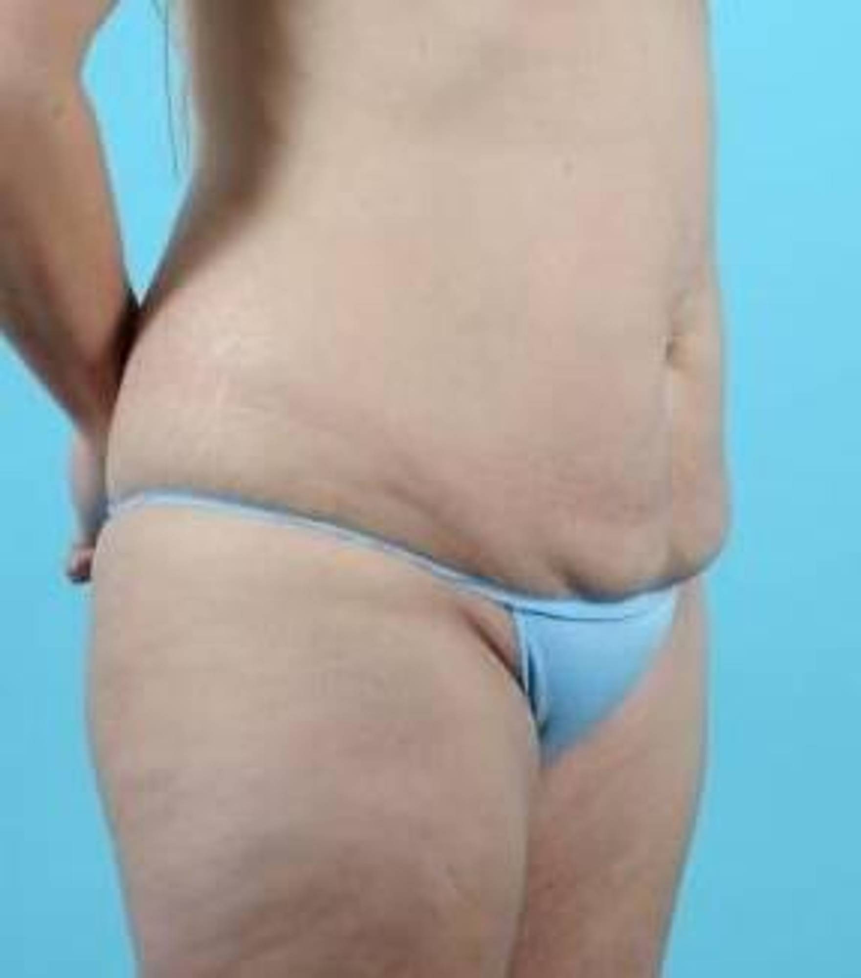 Tummy Tuck Before & After Image