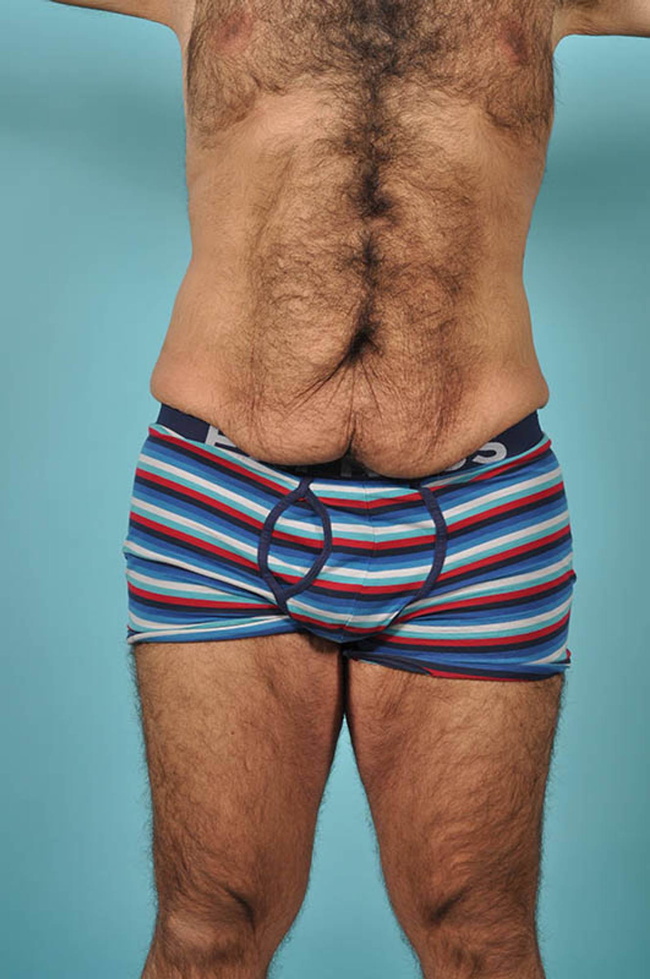 Tummy Tuck Before & After Image