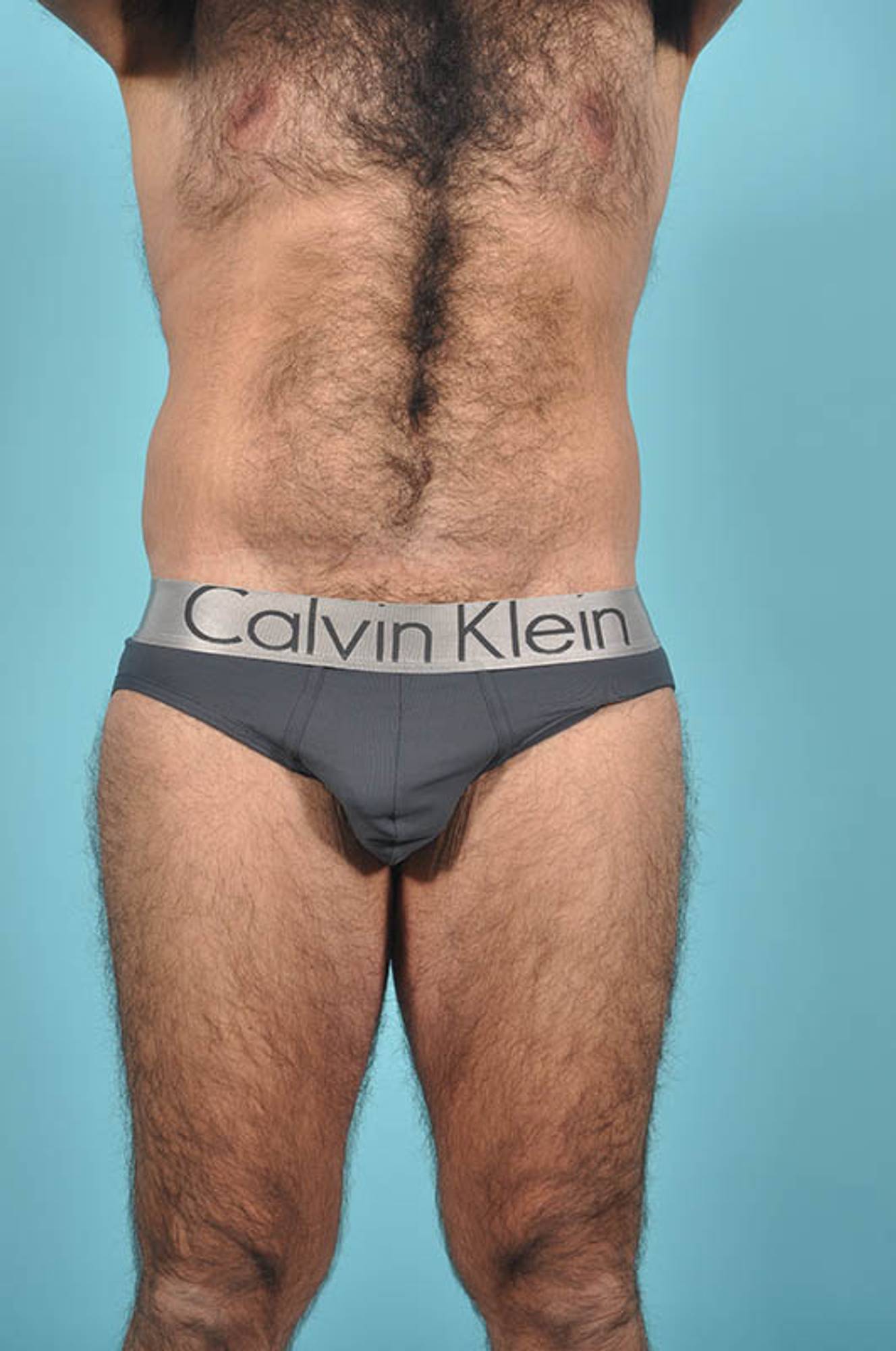 Tummy Tuck Before & After Image