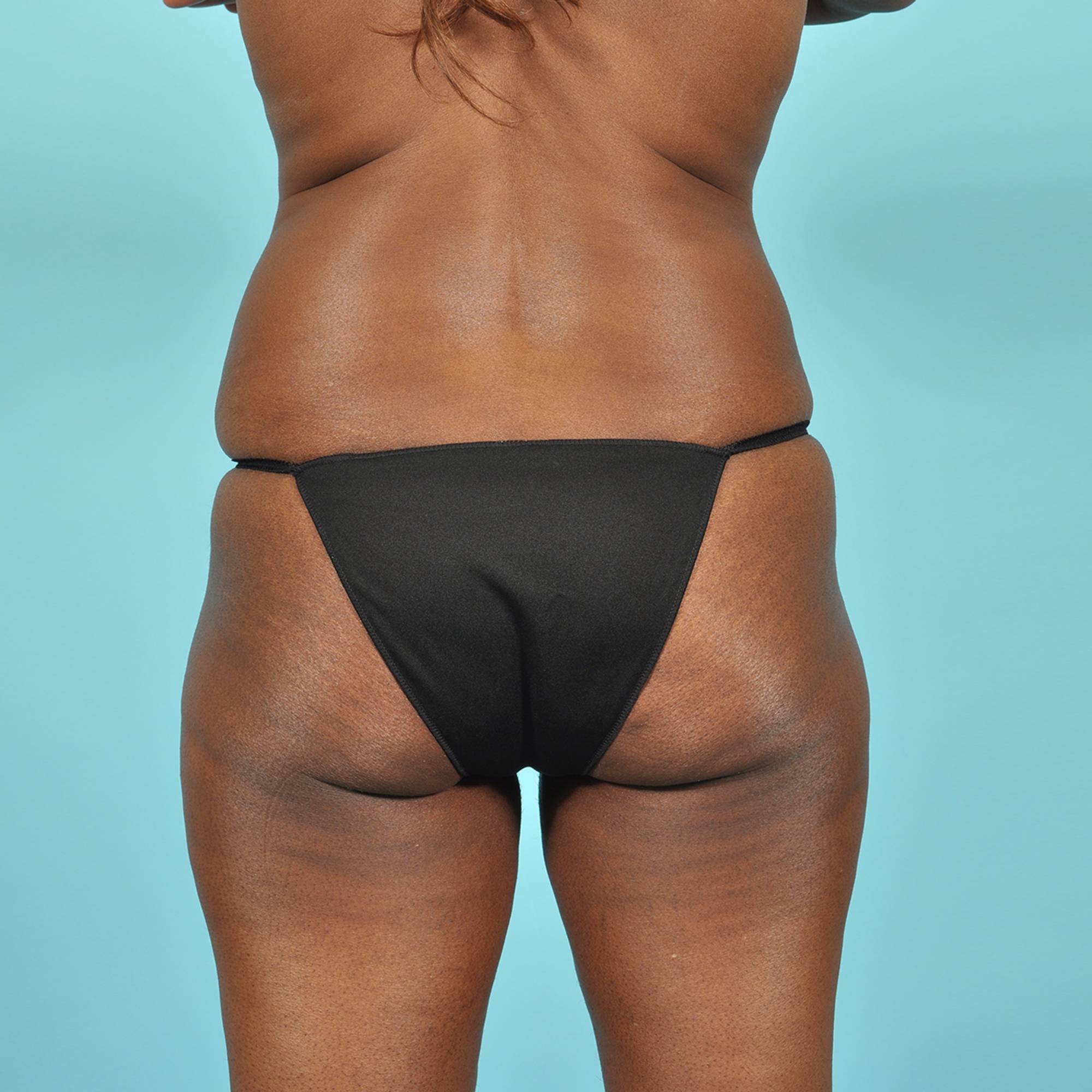 Tummy Tuck Before & After Image