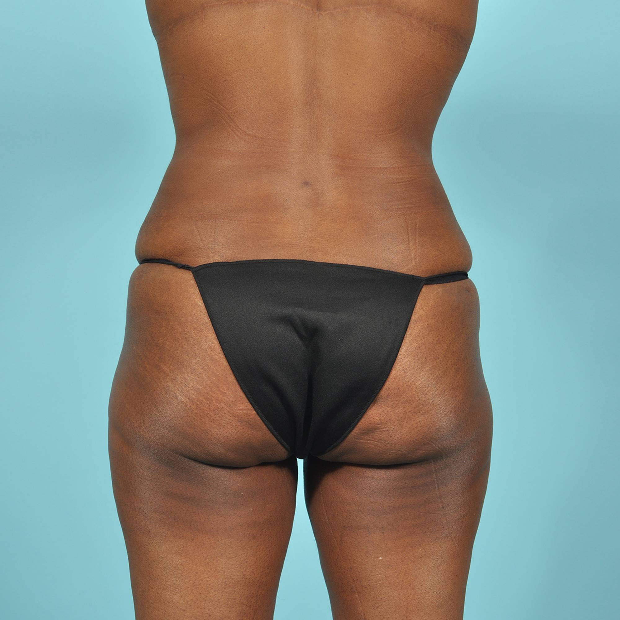 Tummy Tuck Before & After Image