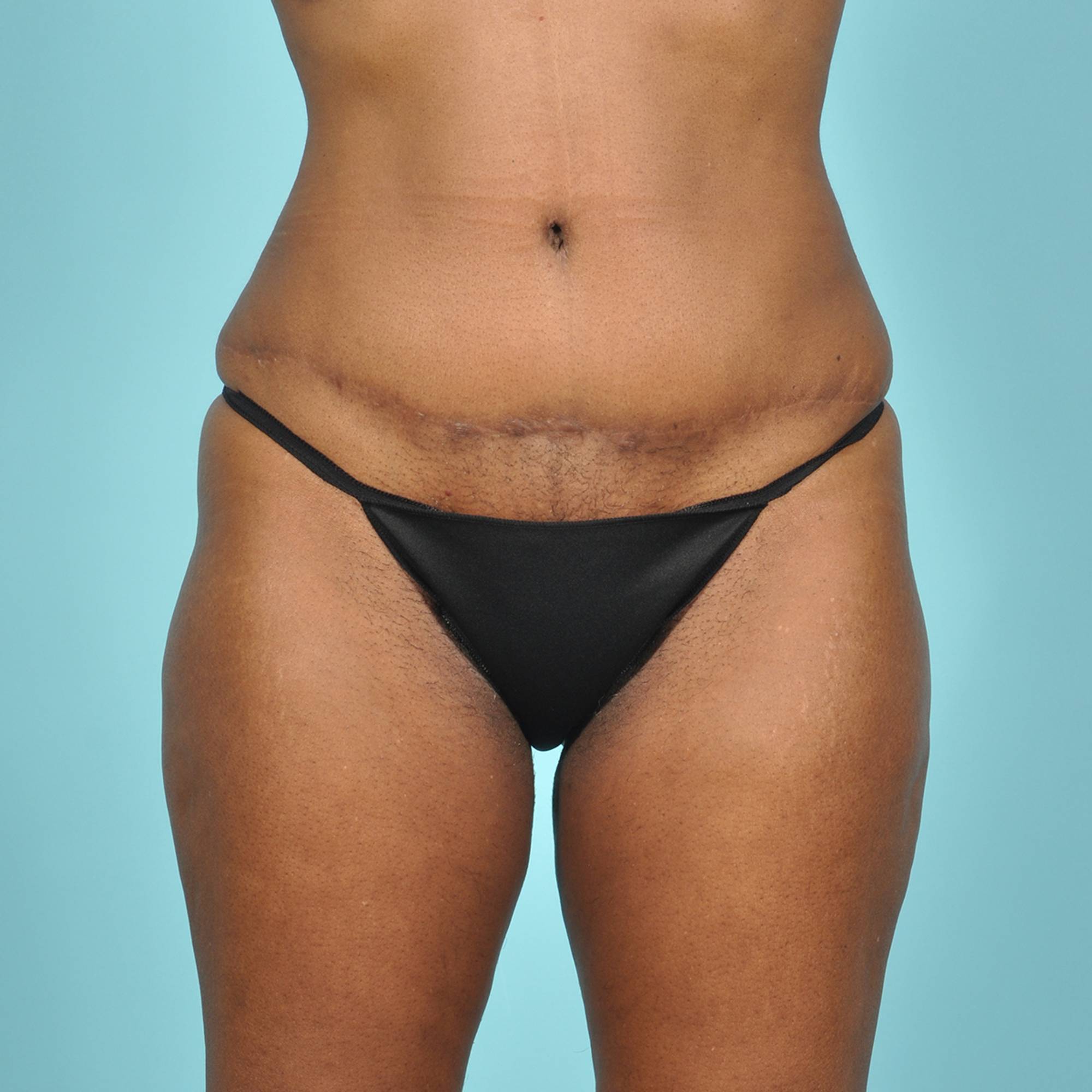  Before & After Image