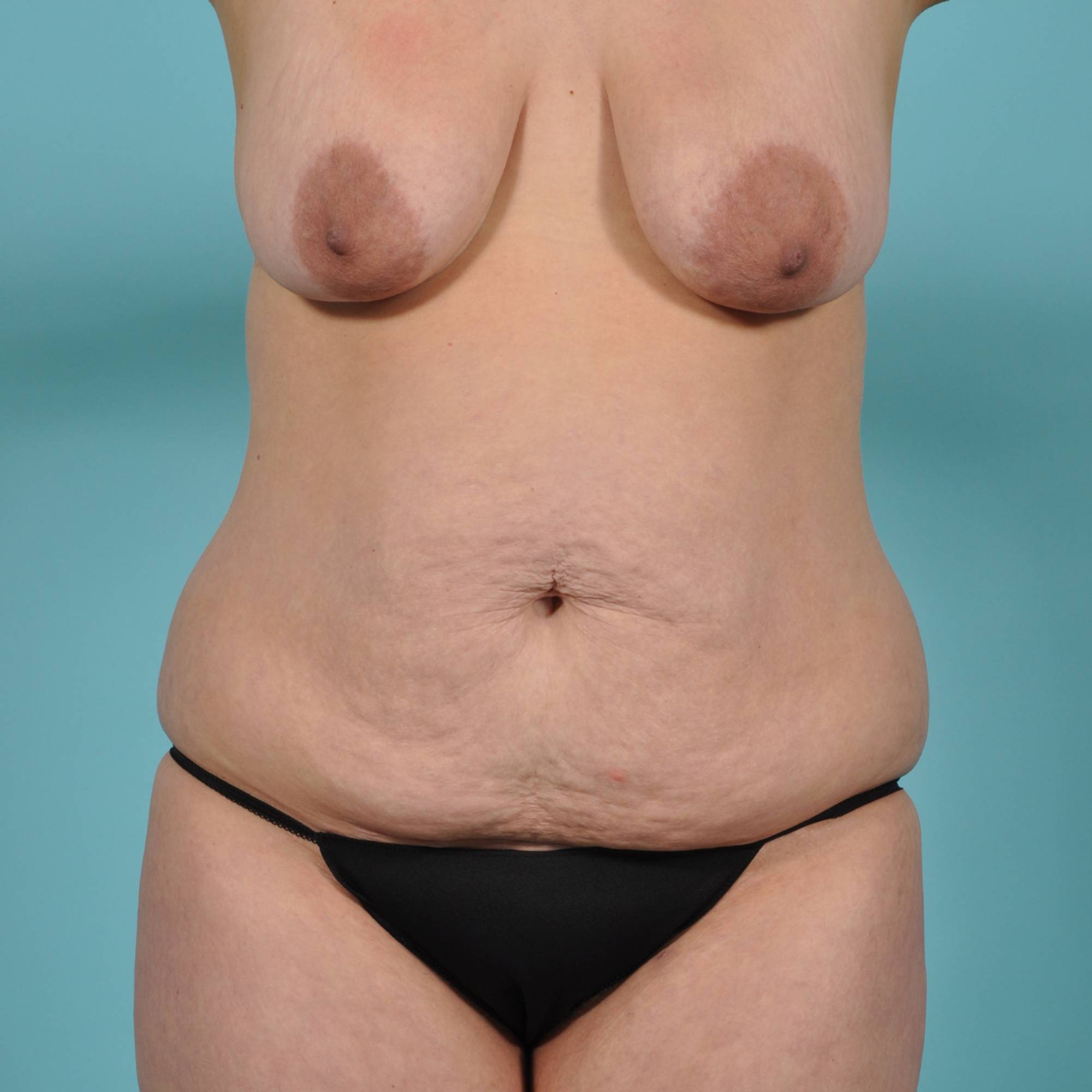 Tummy Tuck Before & After Image