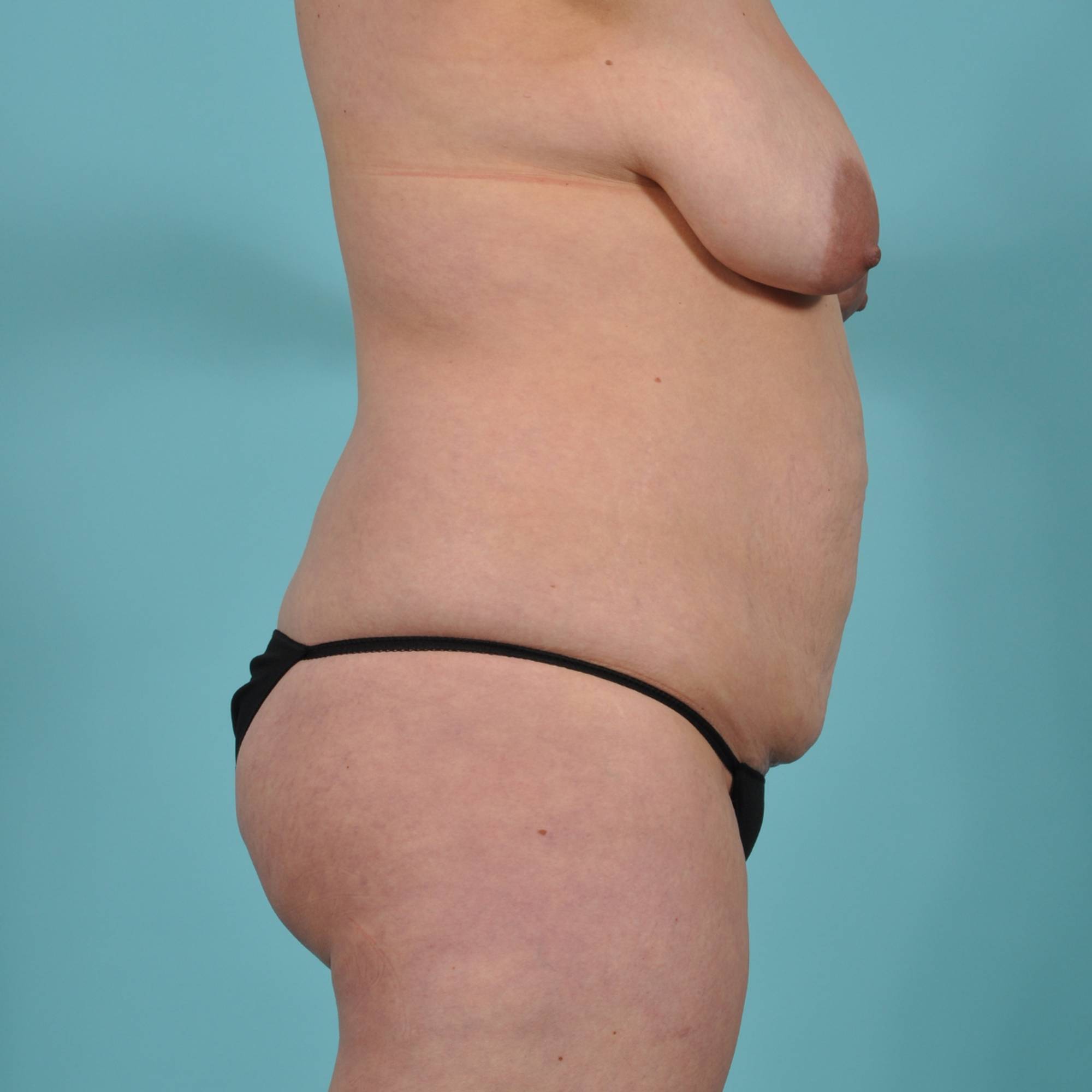 Tummy Tuck Before & After Image