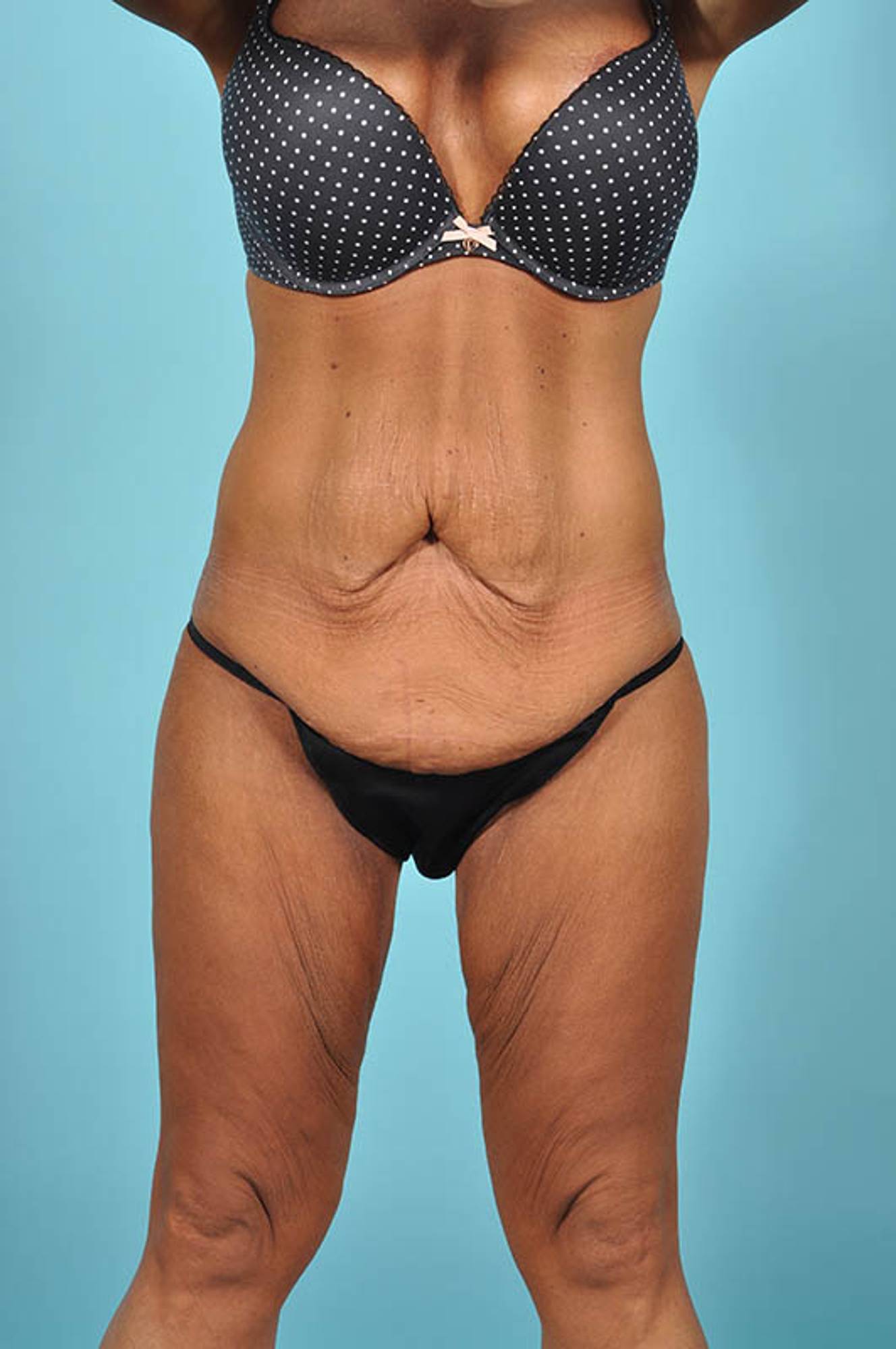 Tummy Tuck Before & After Image