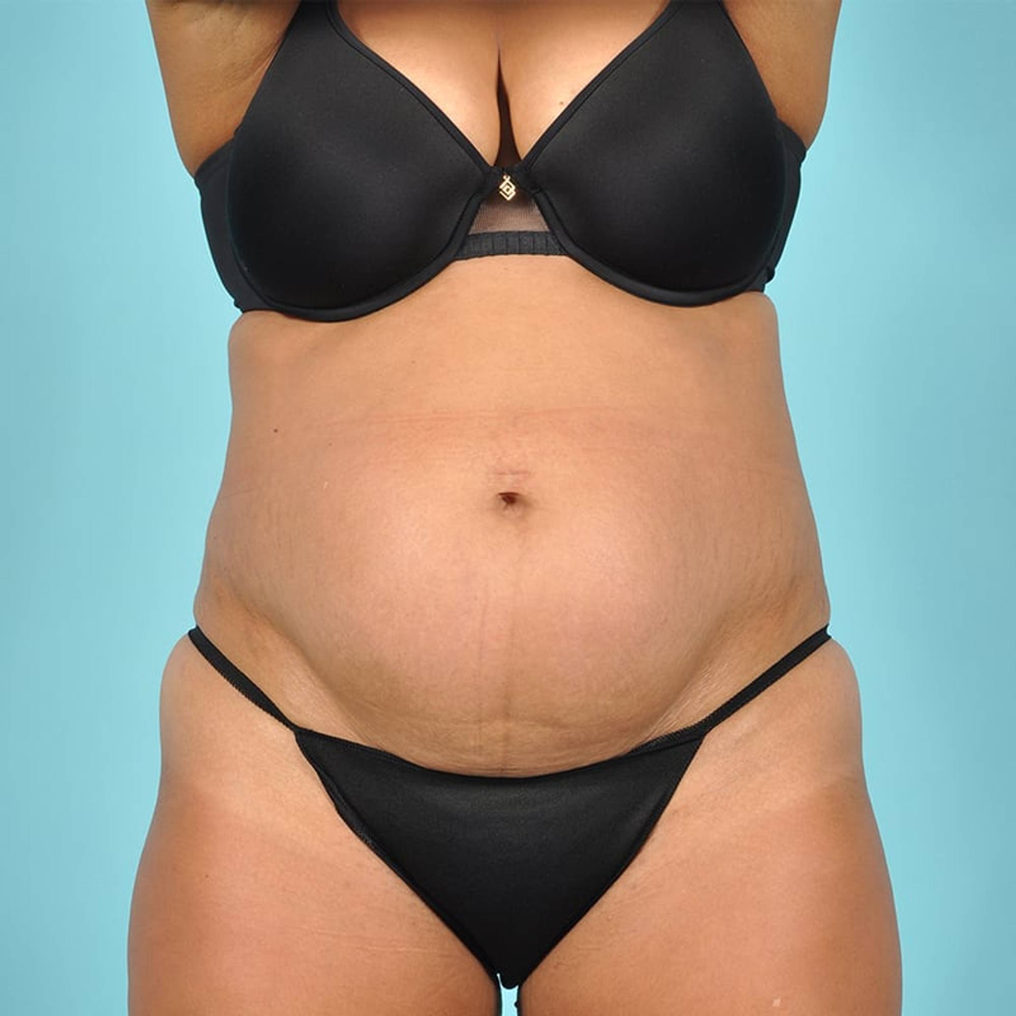 Tummy Tuck Before & After Image