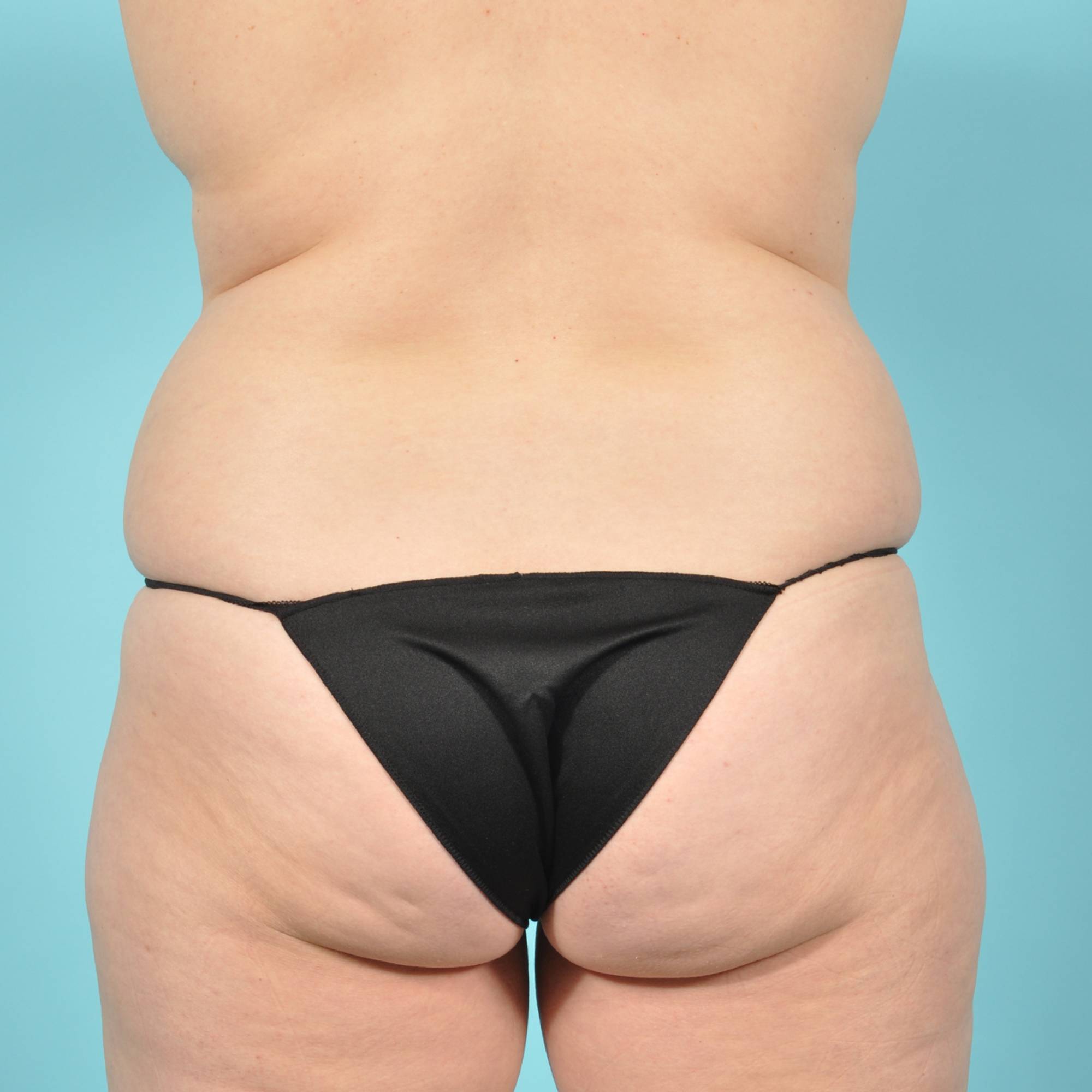 Tummy Tuck Before & After Image