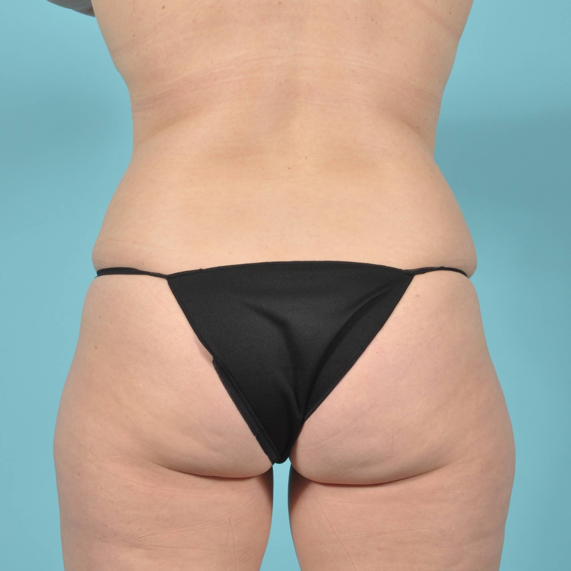 Tummy Tuck Before & After Image