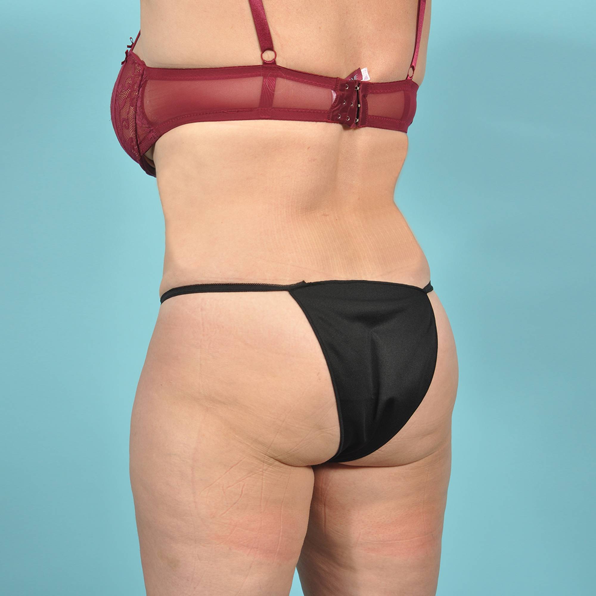 Tummy Tuck Before & After Image