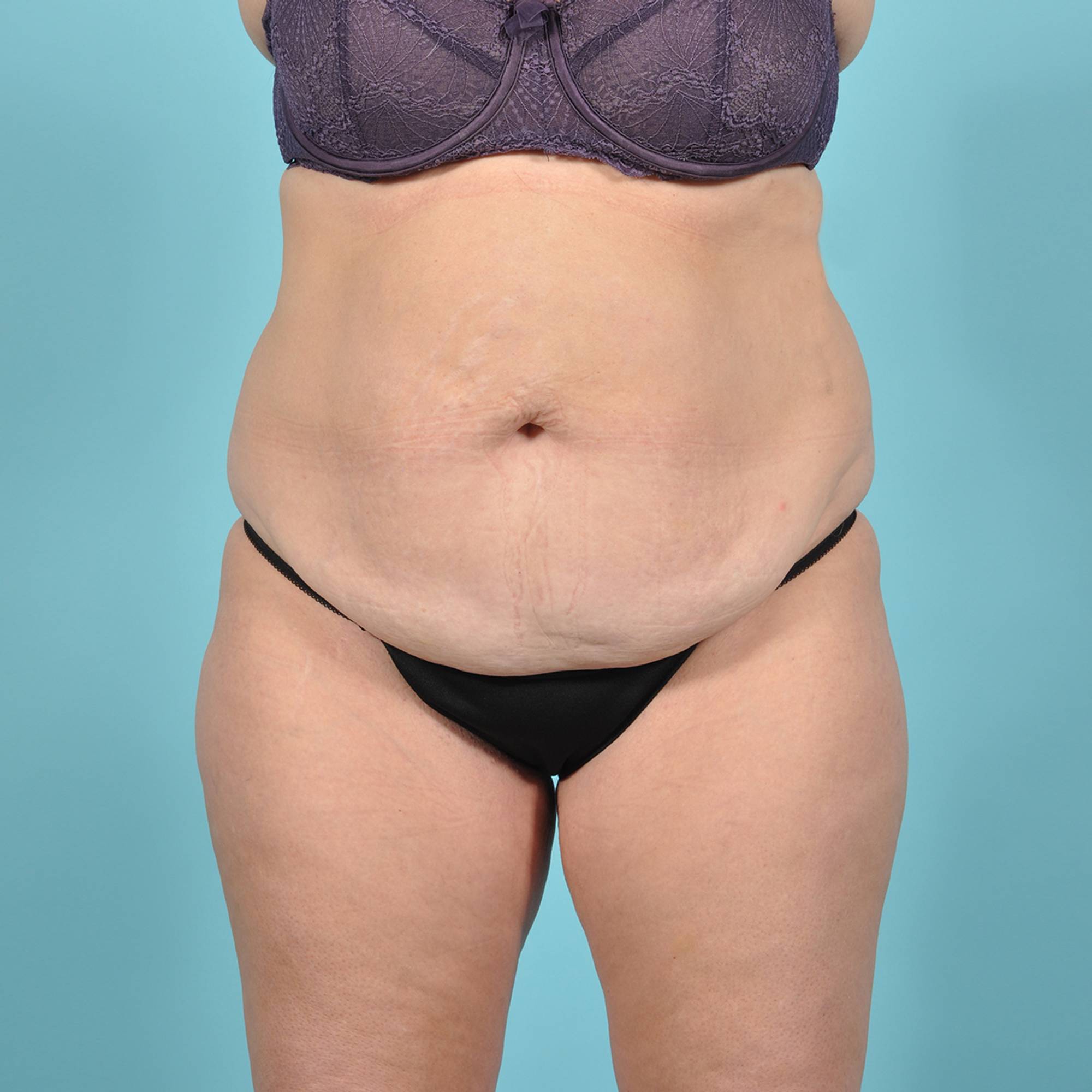 Tummy Tuck Before & After Image