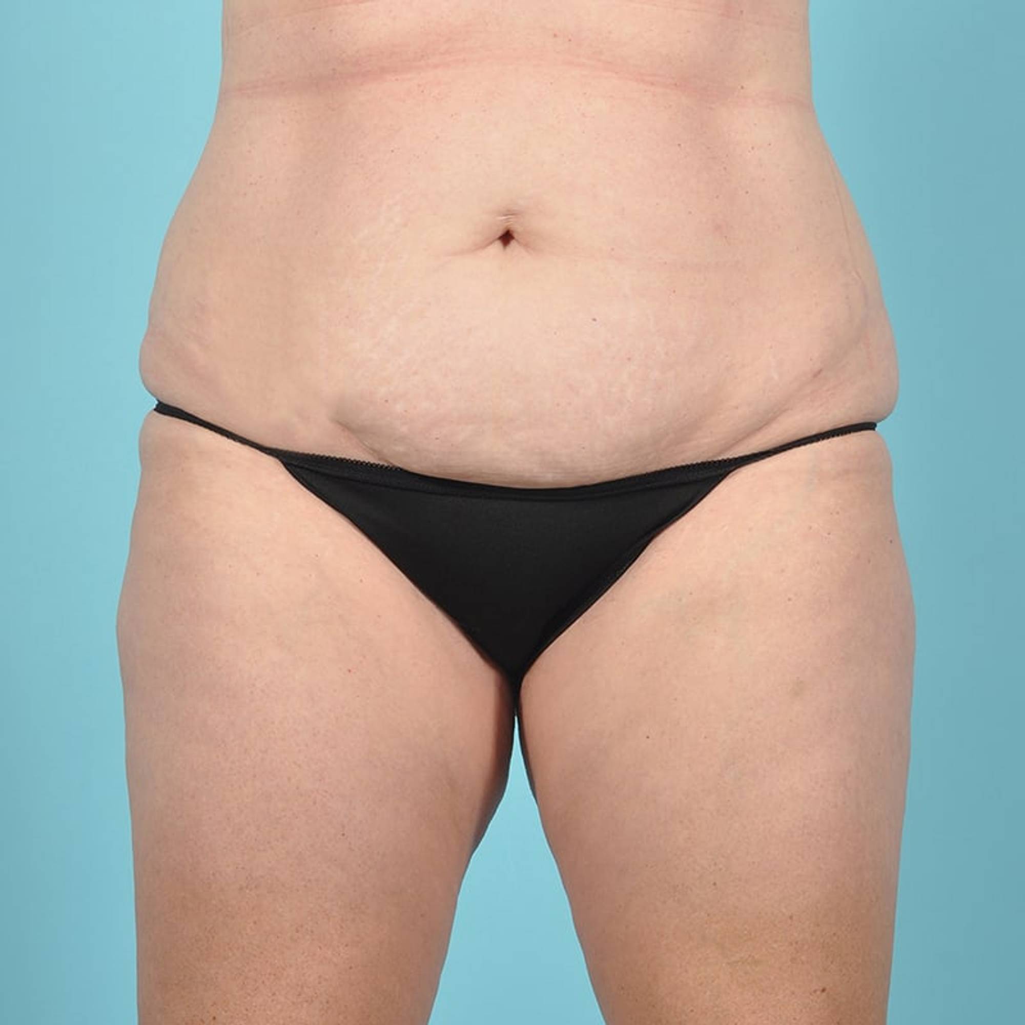 Tummy Tuck Before & After Image