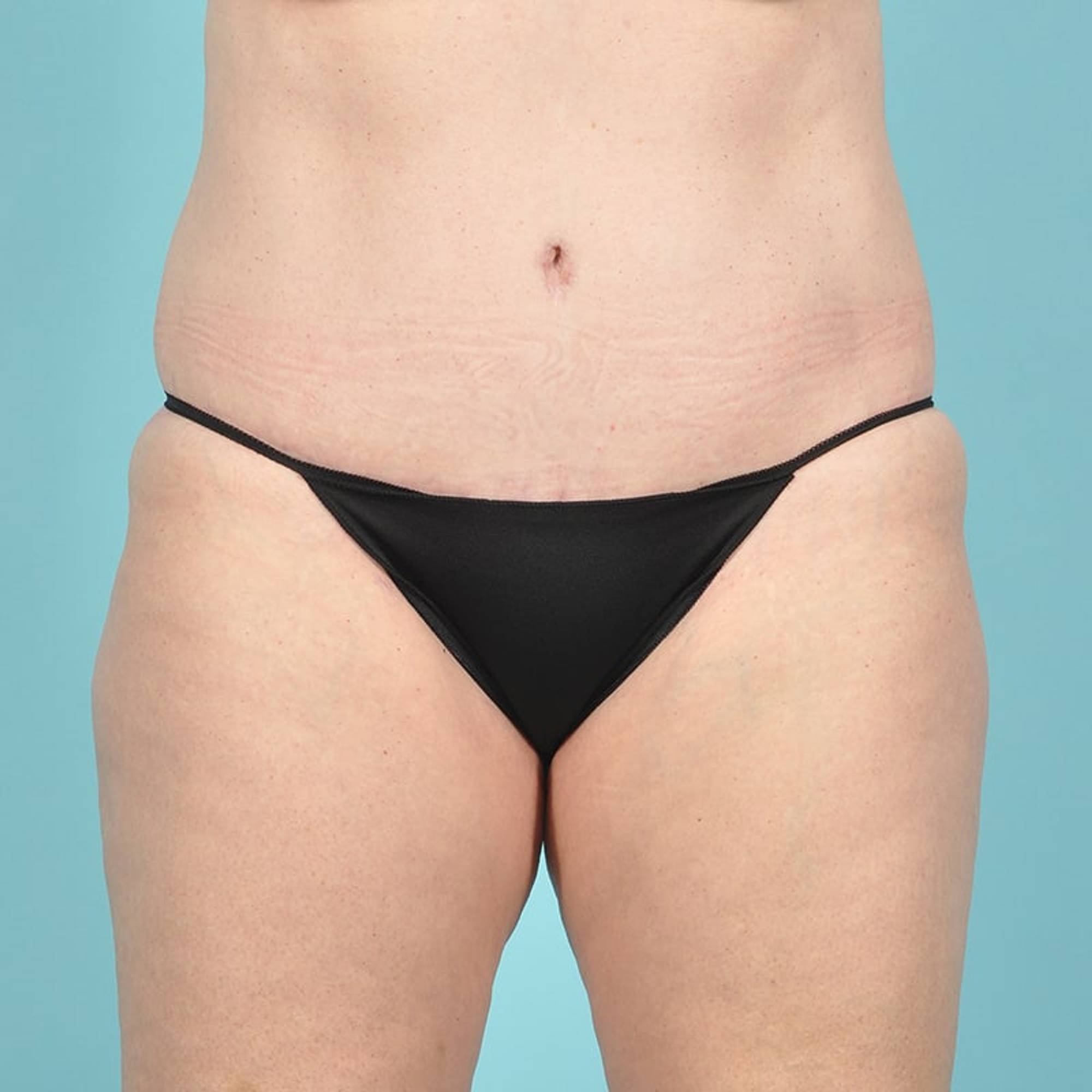Tummy Tuck Before & After Image