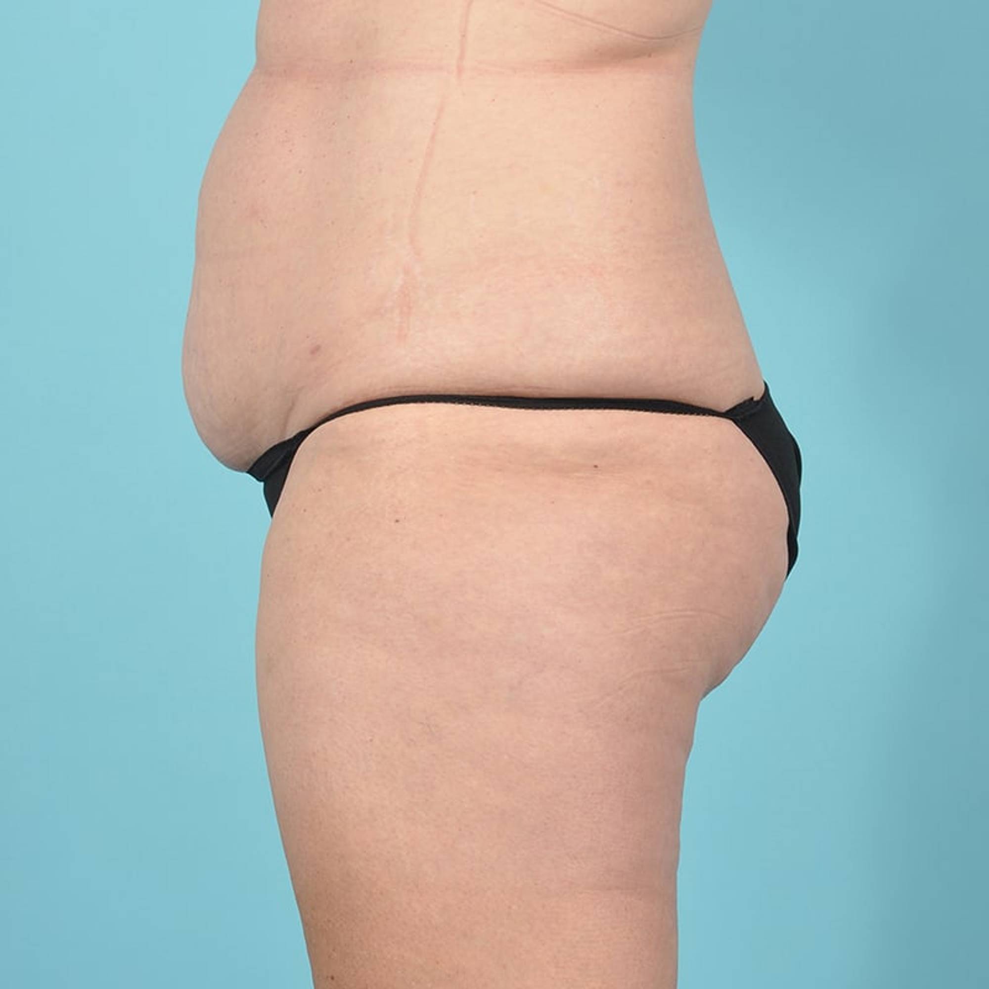 Tummy Tuck Before & After Image
