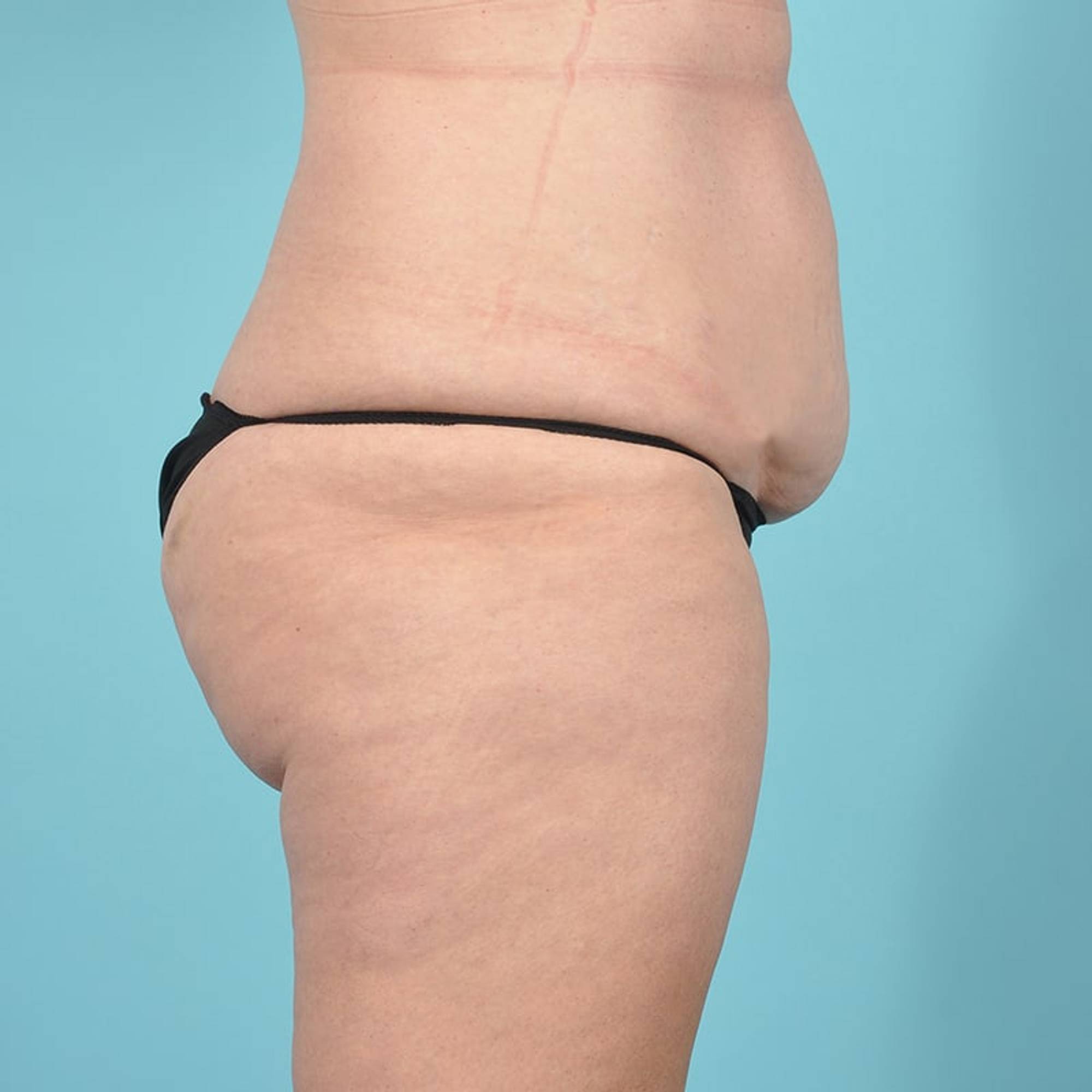 Tummy Tuck Before & After Image