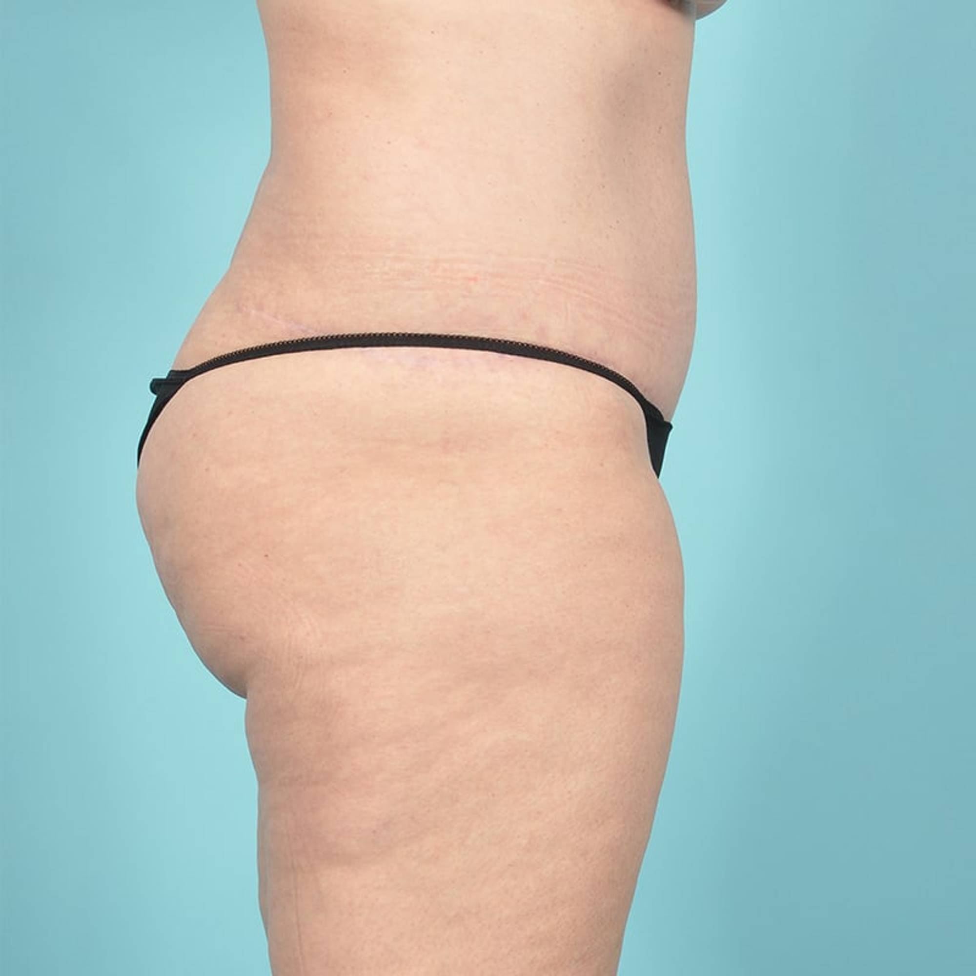 Tummy Tuck Before & After Image