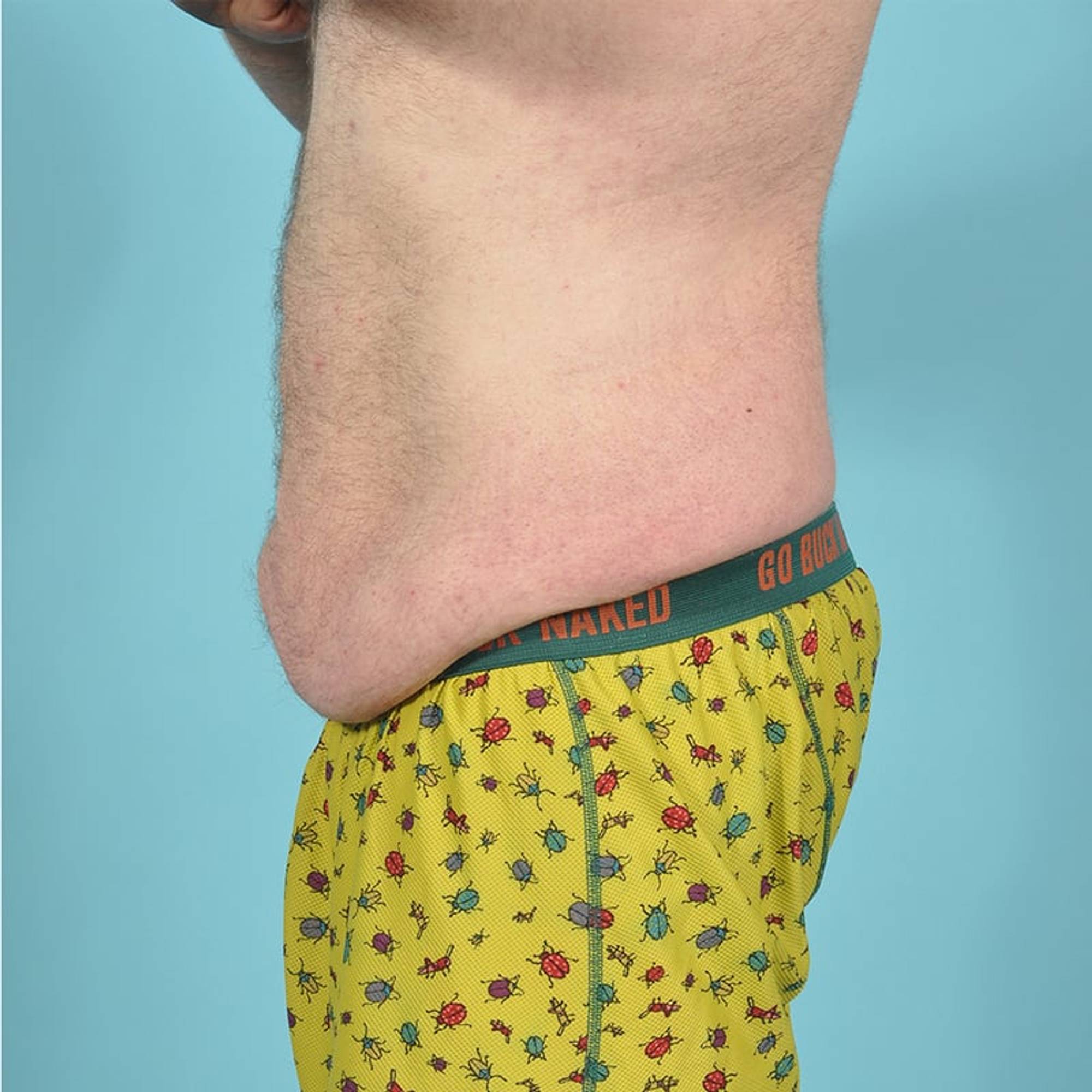 Tummy Tuck Before & After Image