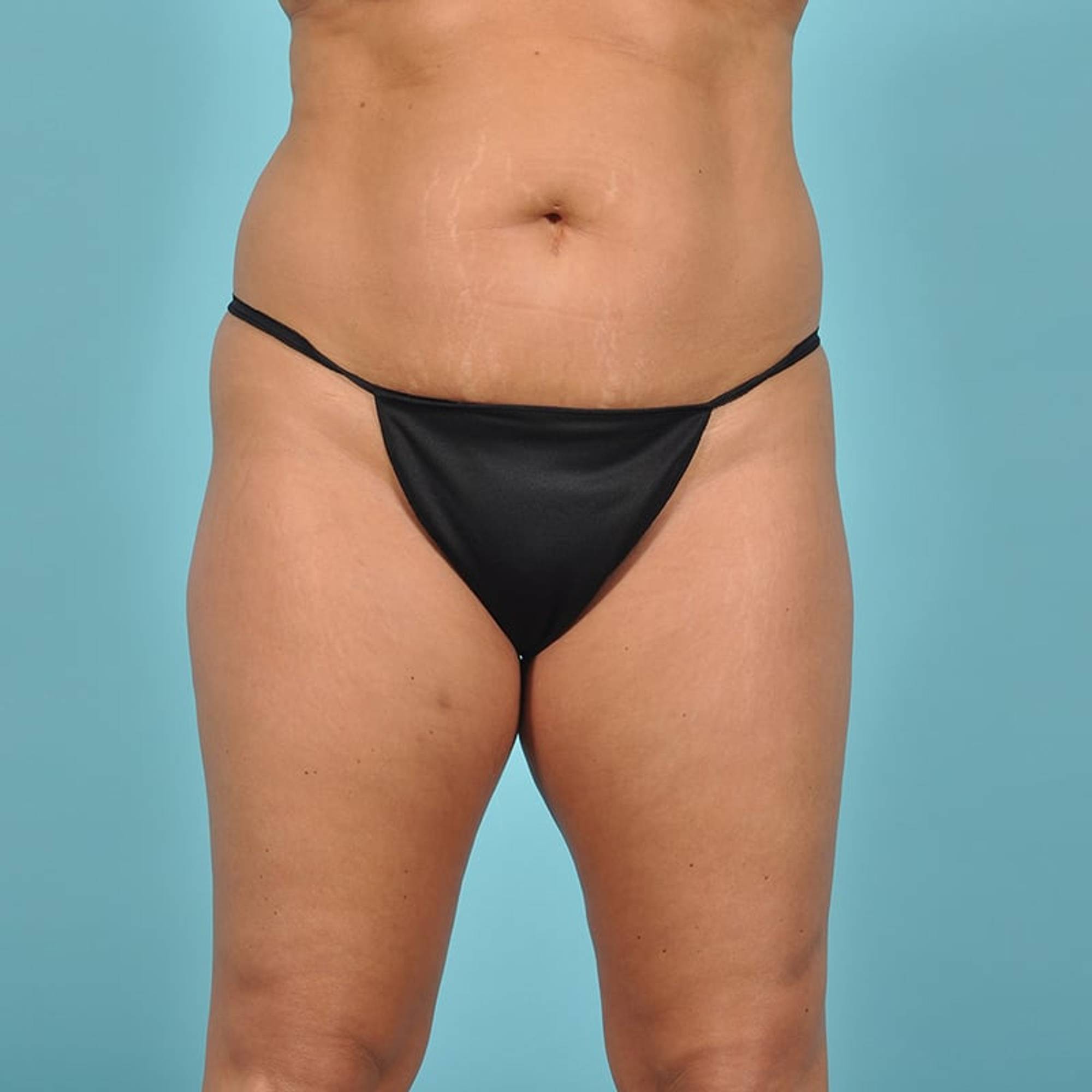 Tummy Tuck Before & After Image