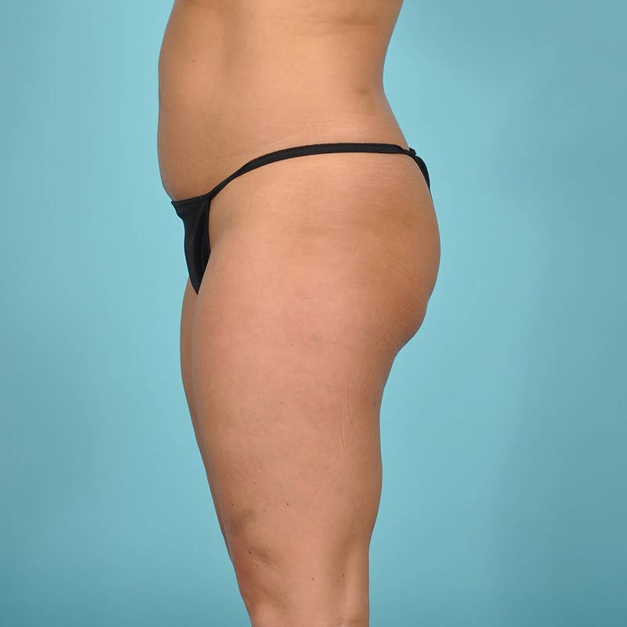 Tummy Tuck Before & After Image