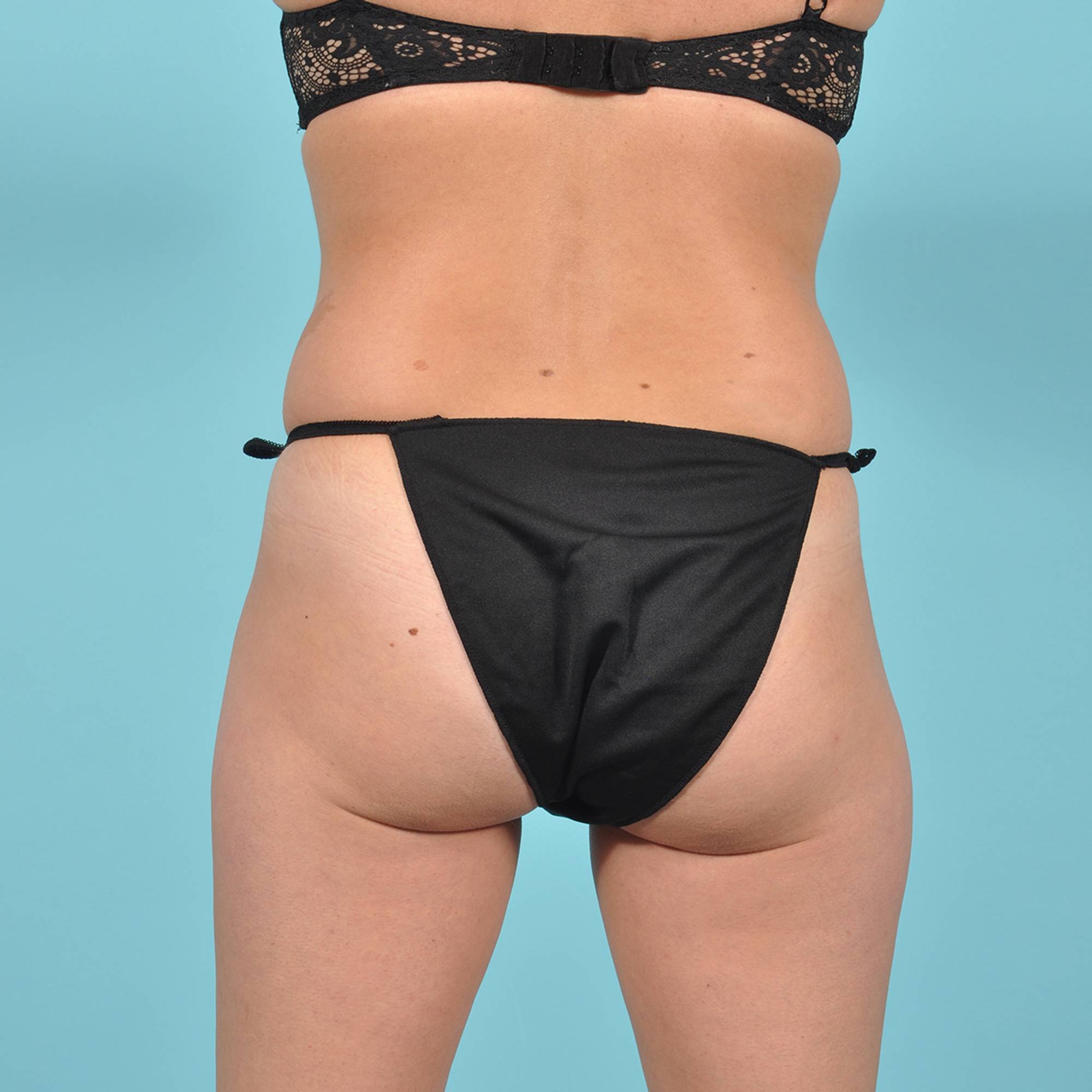 Tummy Tuck Before & After Image