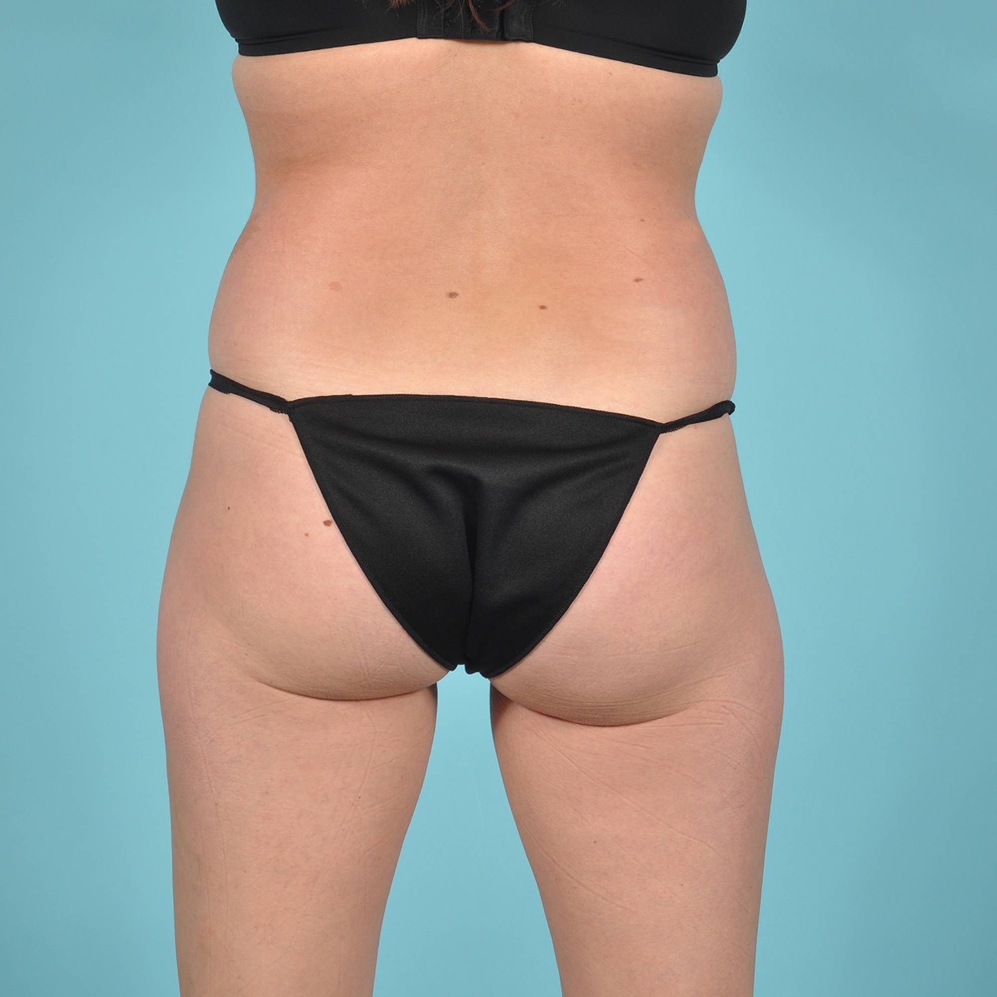 Tummy Tuck Before & After Image